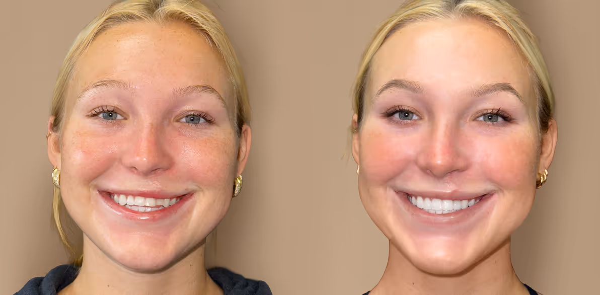 Before and after porcelain veneers by Dr. Kate sahafi - Dovel Dental Newport Beach