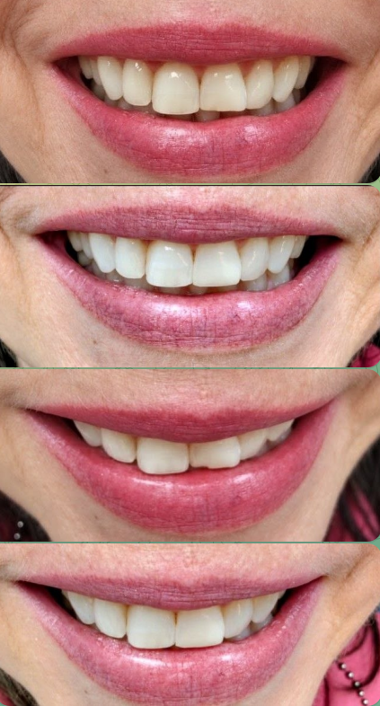 Four close-up smile photographs showing cosmetic dentistry before-and-after views