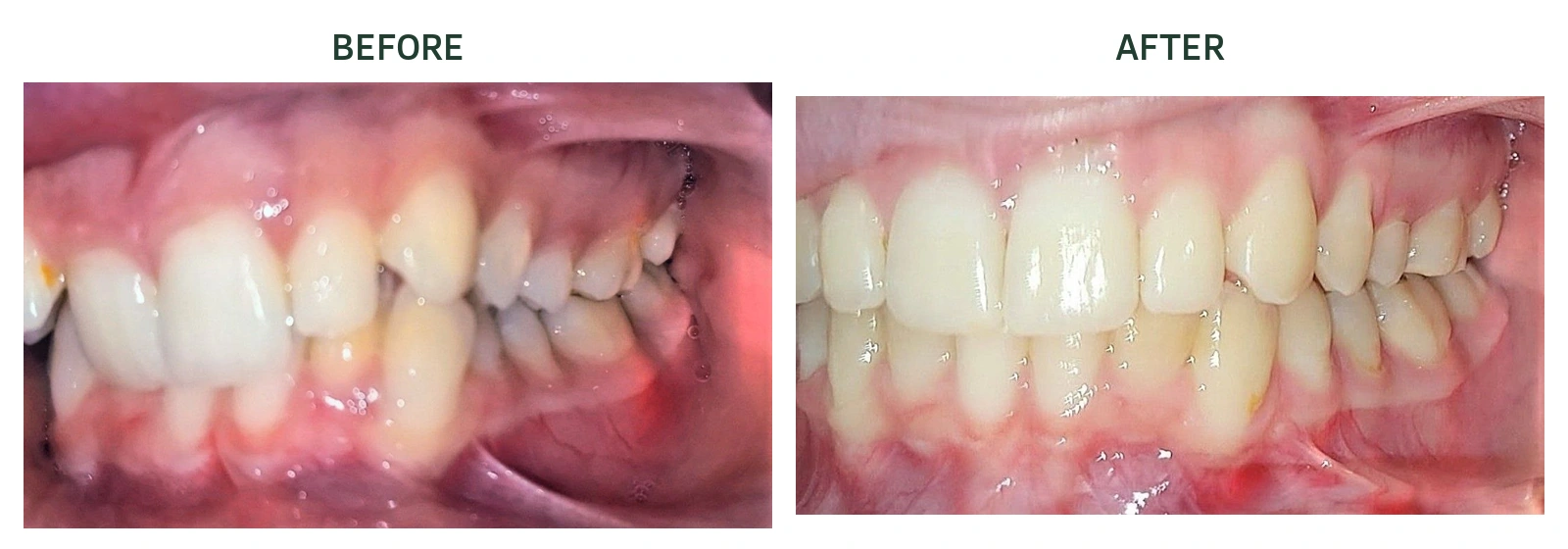 Left-side bite before and after Invisalign treatment at North Arbor Dental in Kitchener; before left, after right.