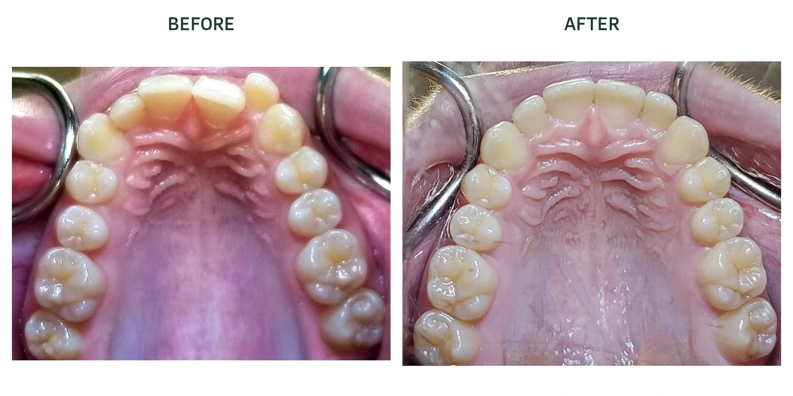 Upper dental arch before and after Invisalign treatment at North Arbor Dental in Kitchener; before left, after right.