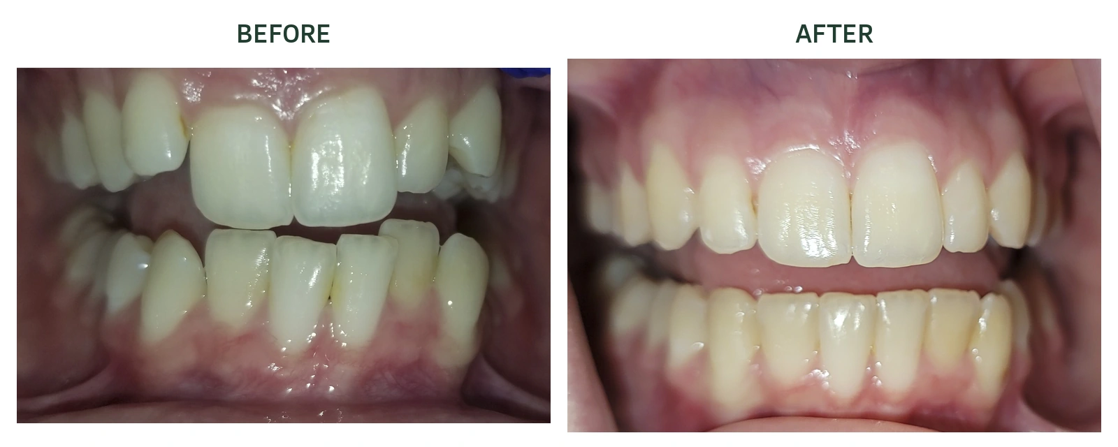 Front view of upper and lower teeth before and after Invisalign at North Arbor Dental; before left, after right.
