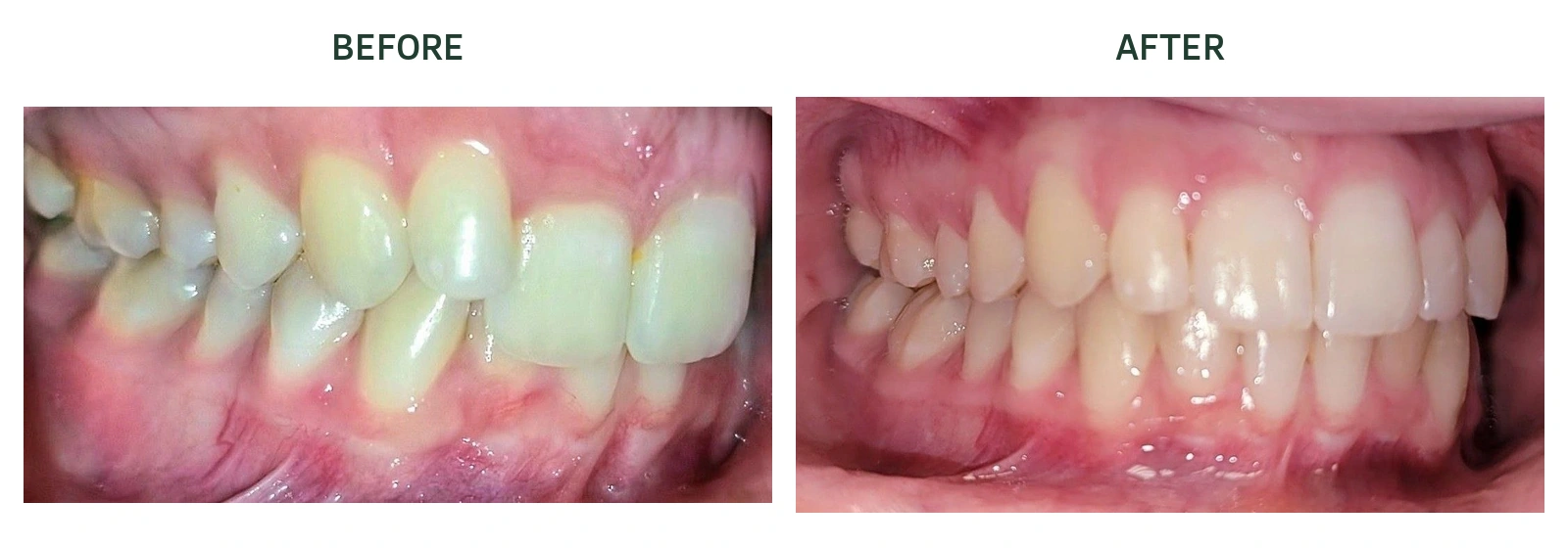 Right-side bite before and after Invisalign treatment at North Arbor Dental in Kitchener; before left, after right.
