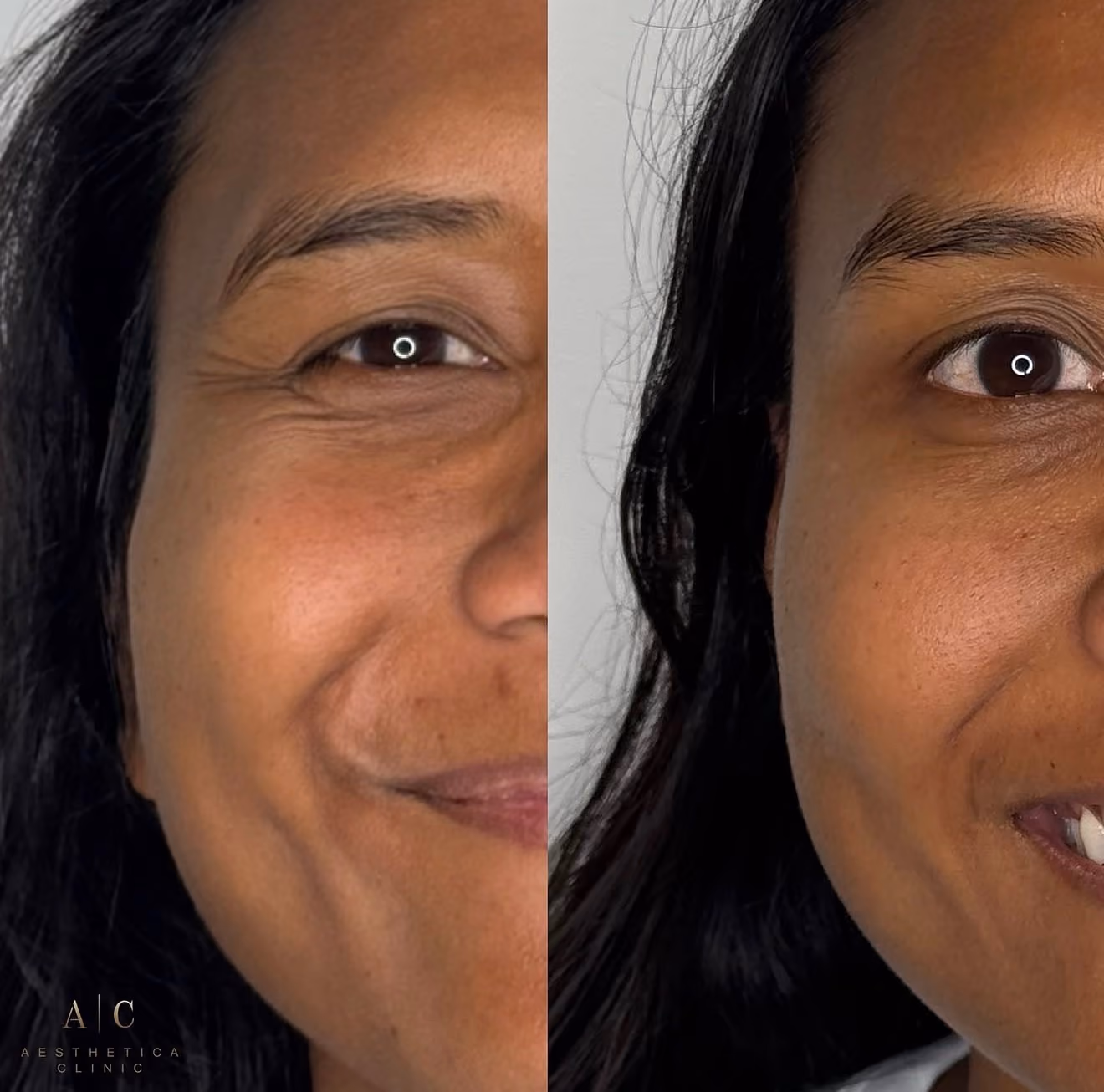 Close-up side-by-side comparison of a woman's face showing reduction in wrinkles and smoother skin texture on the right side, indicating a skin treatment effect.