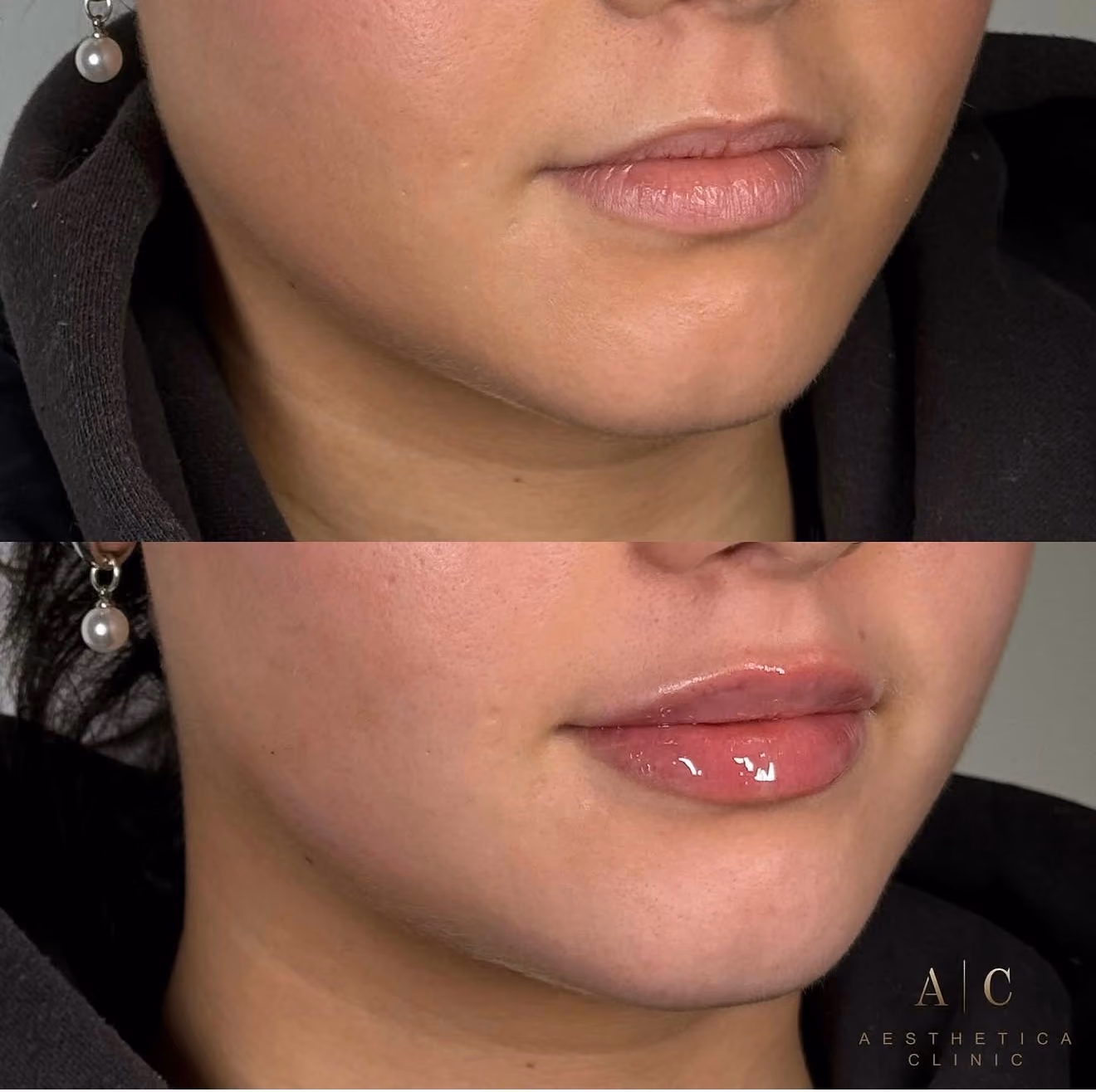 Close-up before-and-after comparison of a woman's lower face, showing lips without gloss on top and lips with shiny pink gloss applied at the bottom, highlighting enhanced lip volume and shine.