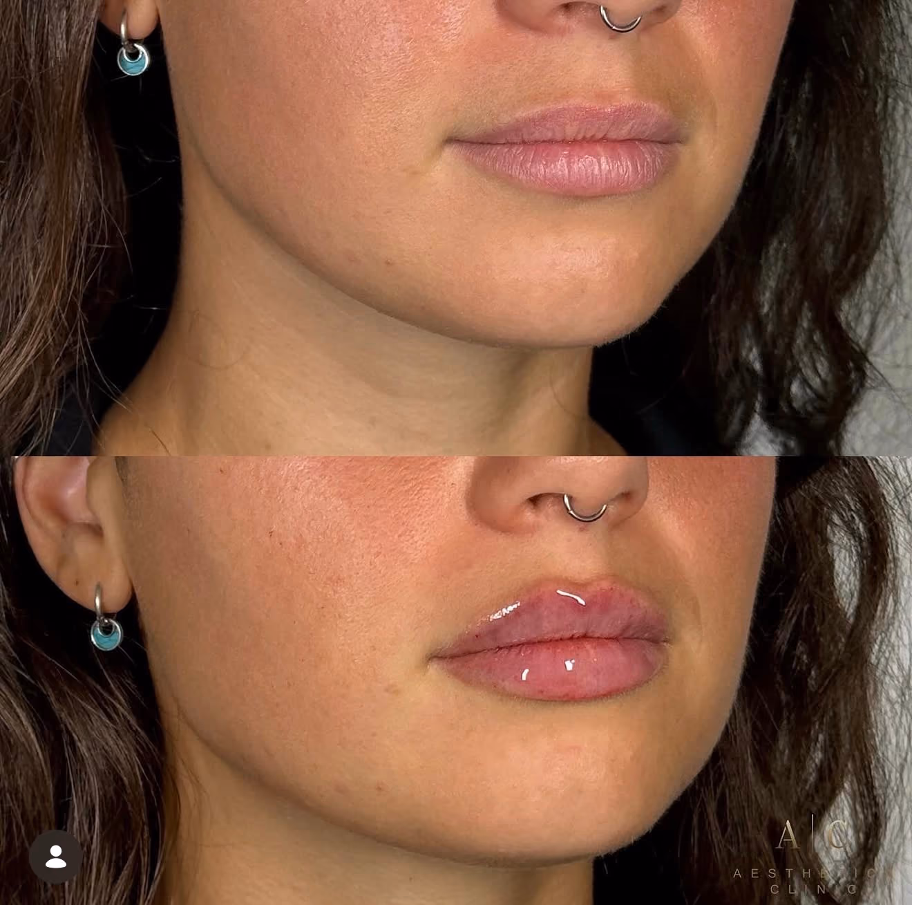 Close-up comparison of a woman's lower face showing before and after lip enhancement: the top image shows natural lips, and the bottom image shows fuller, glossier lips with a septum ring and blue hoop earrings visible in both.