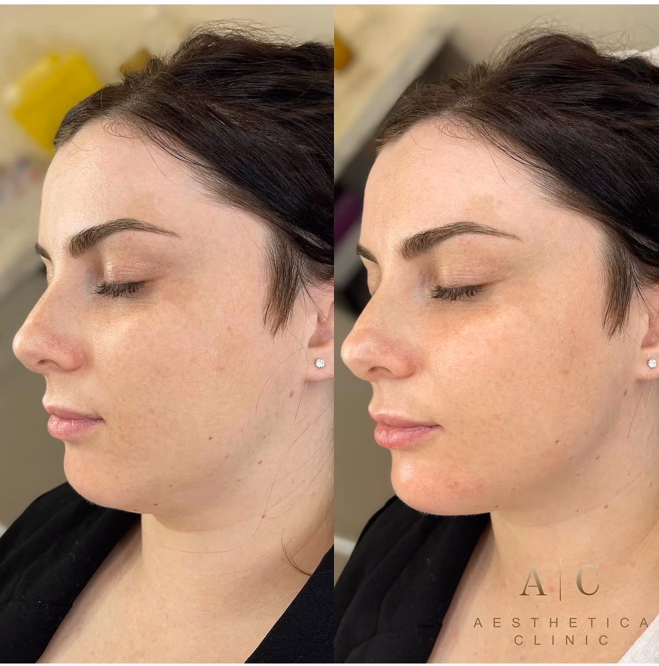 Side-by-side before and after photos of a woman with dark hair showing a subtle improvement in skin texture and reduction in redness and blemishes on her cheek and jawline, photographed with closed eyes and wearing a black garment, with a beige background.