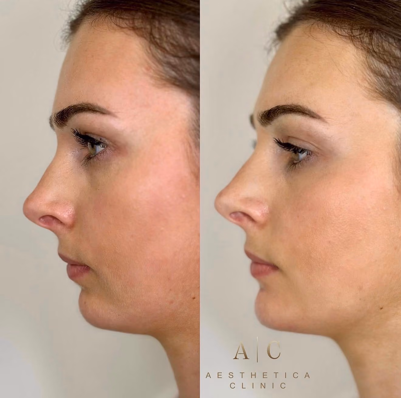 Side-by-side before and after photos of a woman's face showing a smoother jawline and chin contour in the after image, indicating cosmetic improvement.