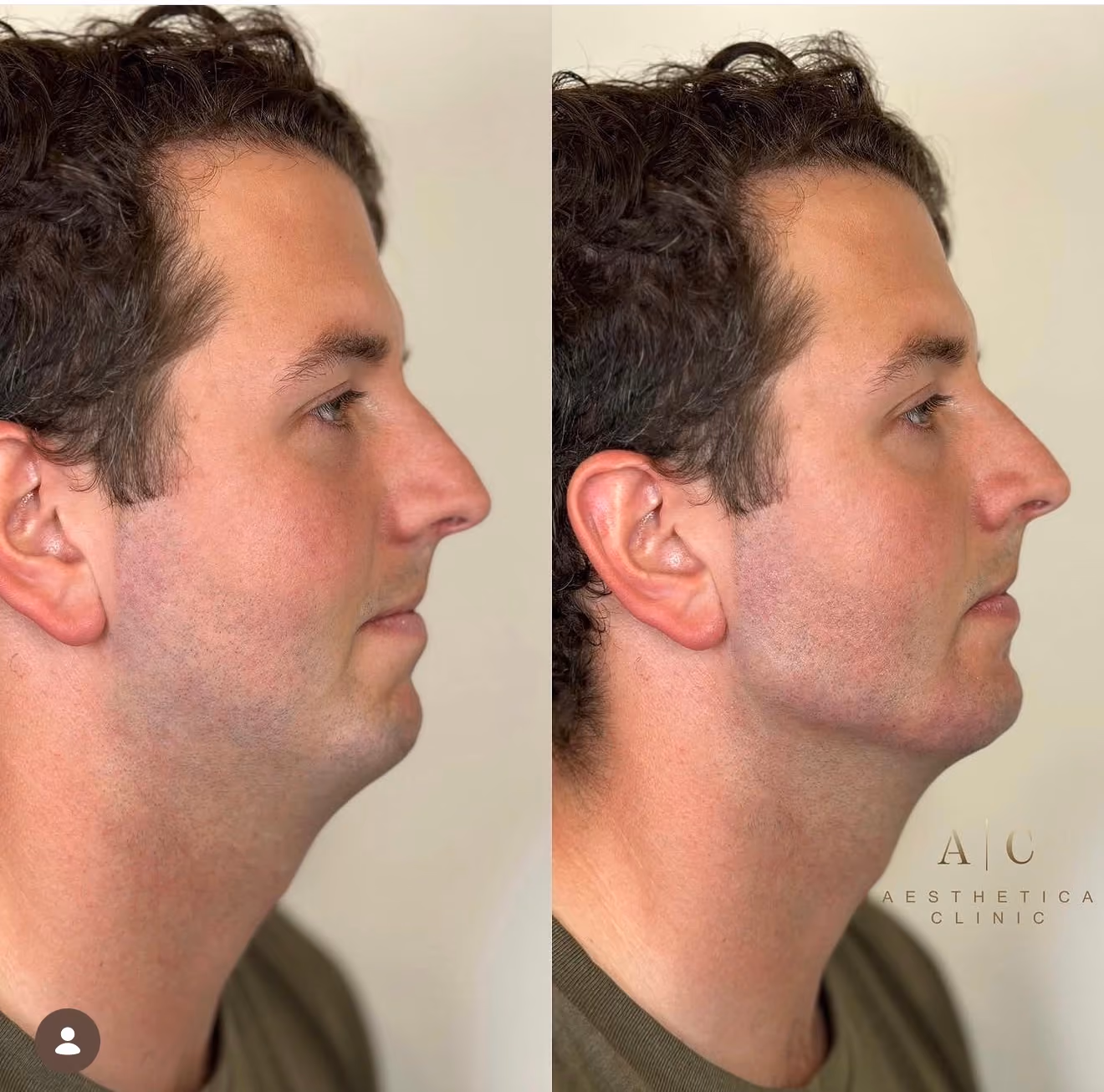 Side-by-side profile photos of a man showing before and after jawline contouring; the after image on the right shows a more defined jawline and chin.