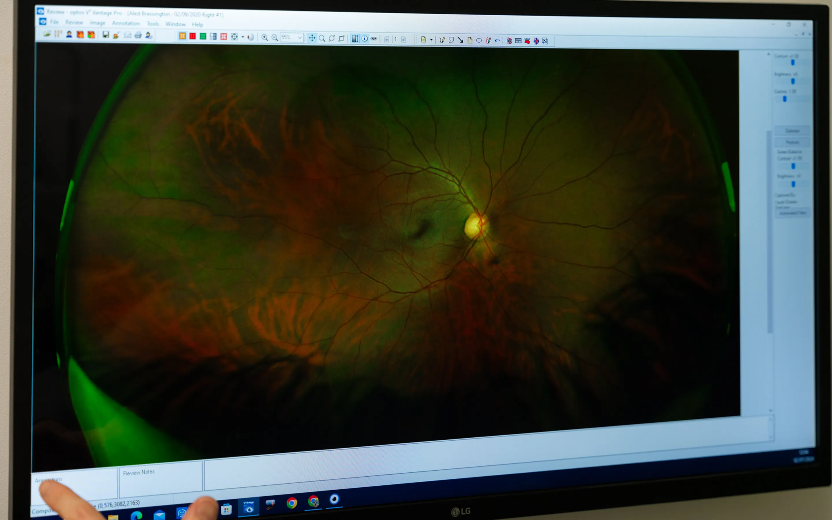 Retinal imaging scan showing myopia detection and eye health assessment at opticians practice