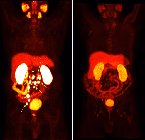 PSMA PET/CT LINKS: Zahlreiche Lymphknoten Metastasen im retroperitonealen Bauchraum und Becken (PSA Tumormarker auf 152 ng/ml erhöht). PSMA PET/CT RECHTS: Vollständige Remission nach 6 Zyklen (PSA Tumormarker 0,18 ng/ml).