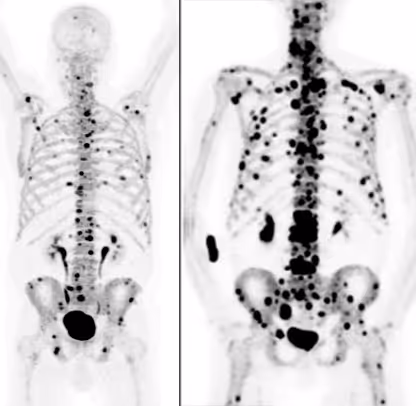 Left: Numerous bone metastases on PSMA PET/CT (PSA tumor marker: 123 ng/mL).  Right: Lymph node metastases in the small pelvis (PSA tumor marker: 23 ng/mL).