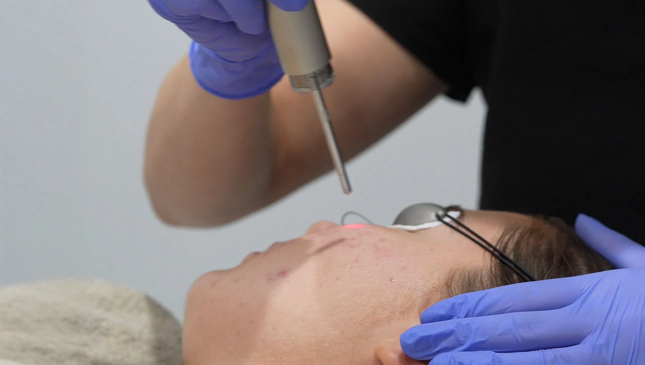 Traitement au laser sur le visage d'une personne portant des lunettes de protection, tenu par une main gantée bleue.