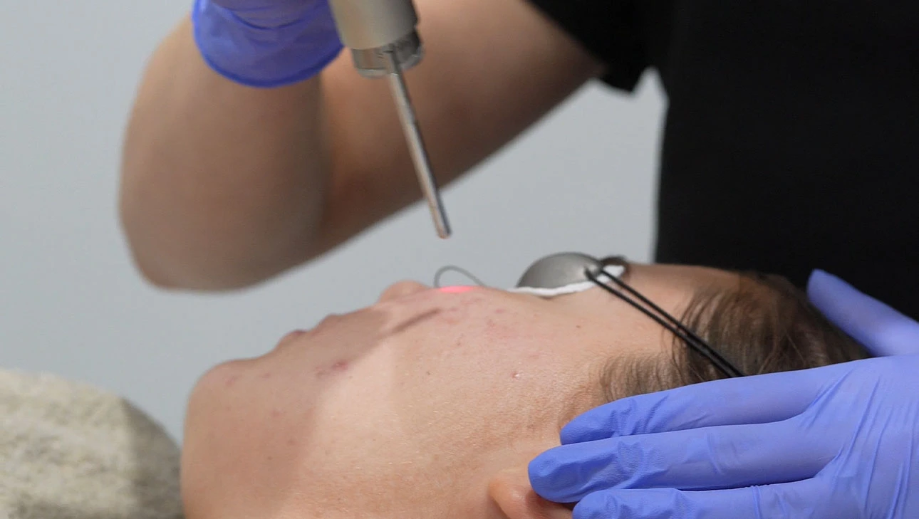 Traitement au laser sur le visage d'une personne allongée portant des lunettes de protection.