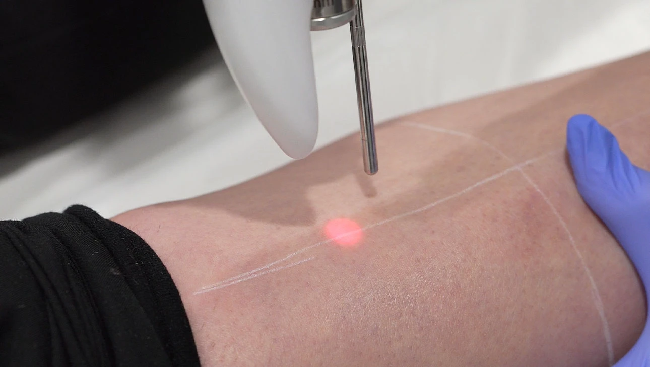 Appareil de laser à épilation pointant un faisceau rouge sur la peau d'un bras marqué de lignes blanches.