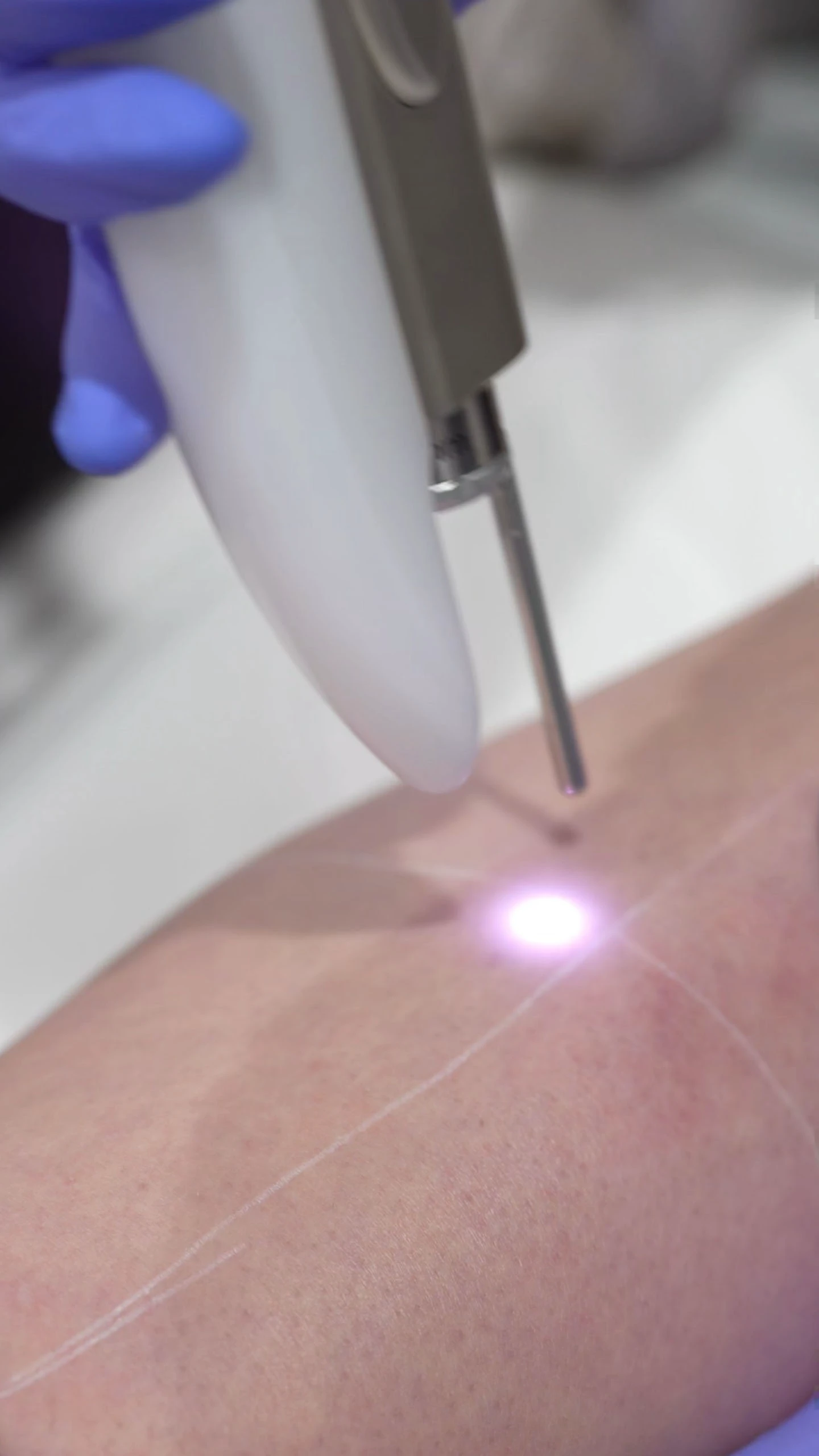 Traitement d'épilation au laser sur la peau avec un appareil tenu par une main gantée.