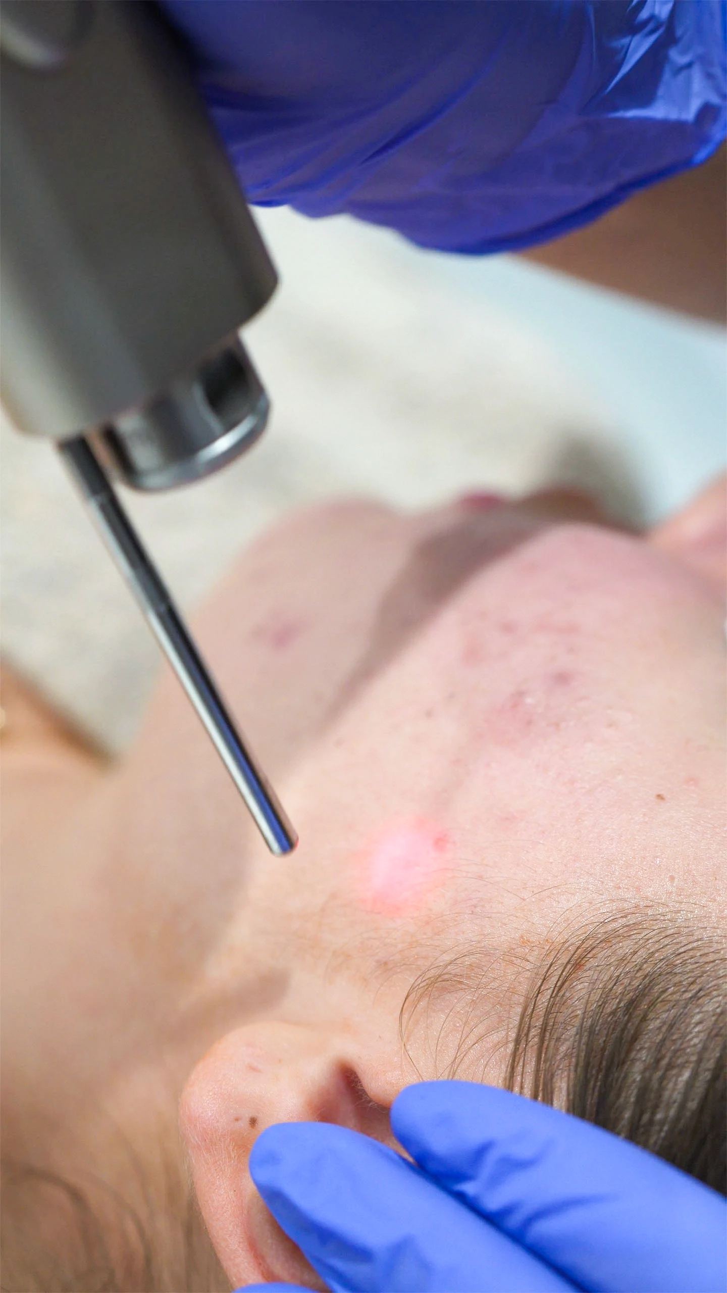 Traitement au laser d'un bouton d'acné sur le front d'une personne par un professionnel portant des gants bleus.