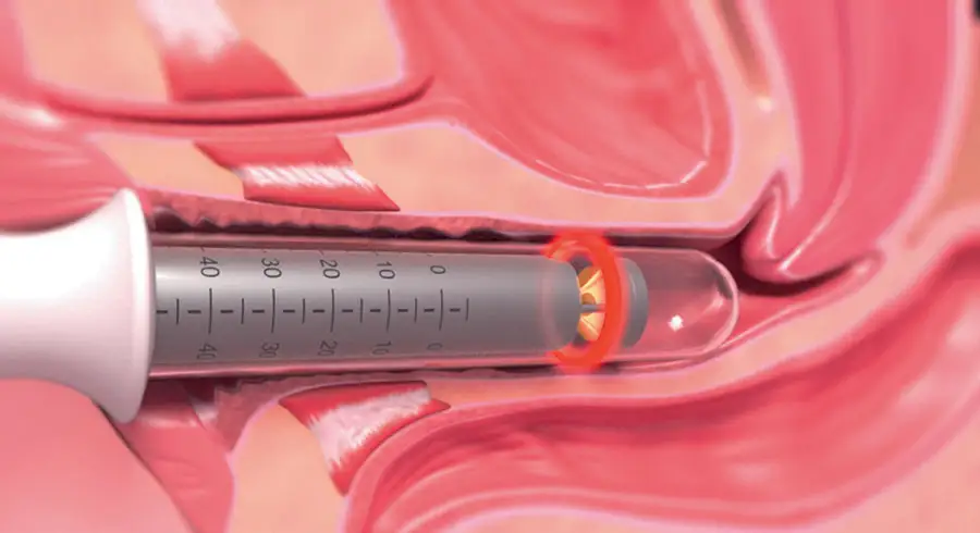 Illustration d'un dispositif médical inséré à l'intérieur du vagin avec une lumière laser émise depuis son extrémité pour un traitement de resserrement vaginal.