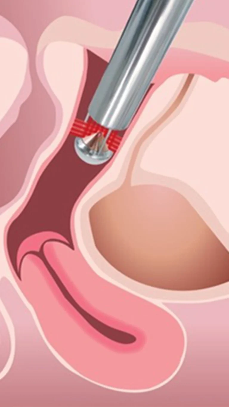 Illustration d'un instrument laser inséré dans le canal vaginal pour un traitement médical ciblé.