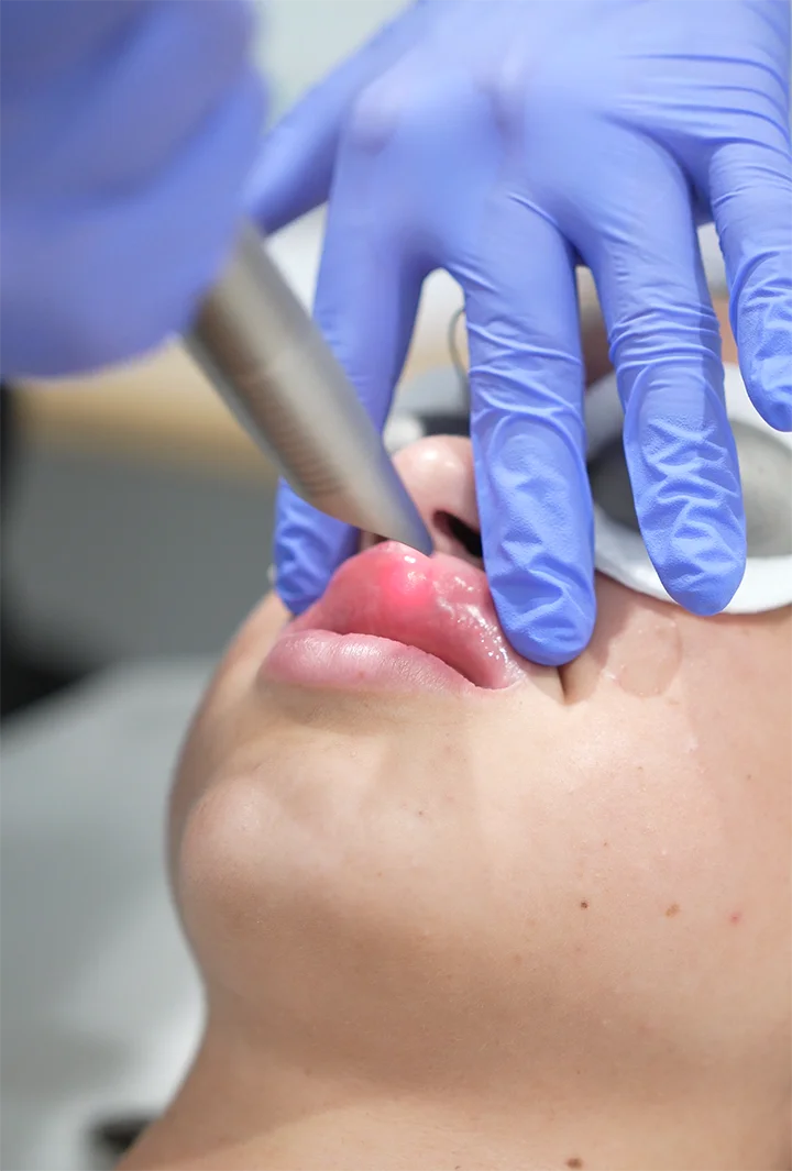 Gant bleu d'un professionnel appliquant un traitement laser sur la lèvre supérieure d'une personne allongée.