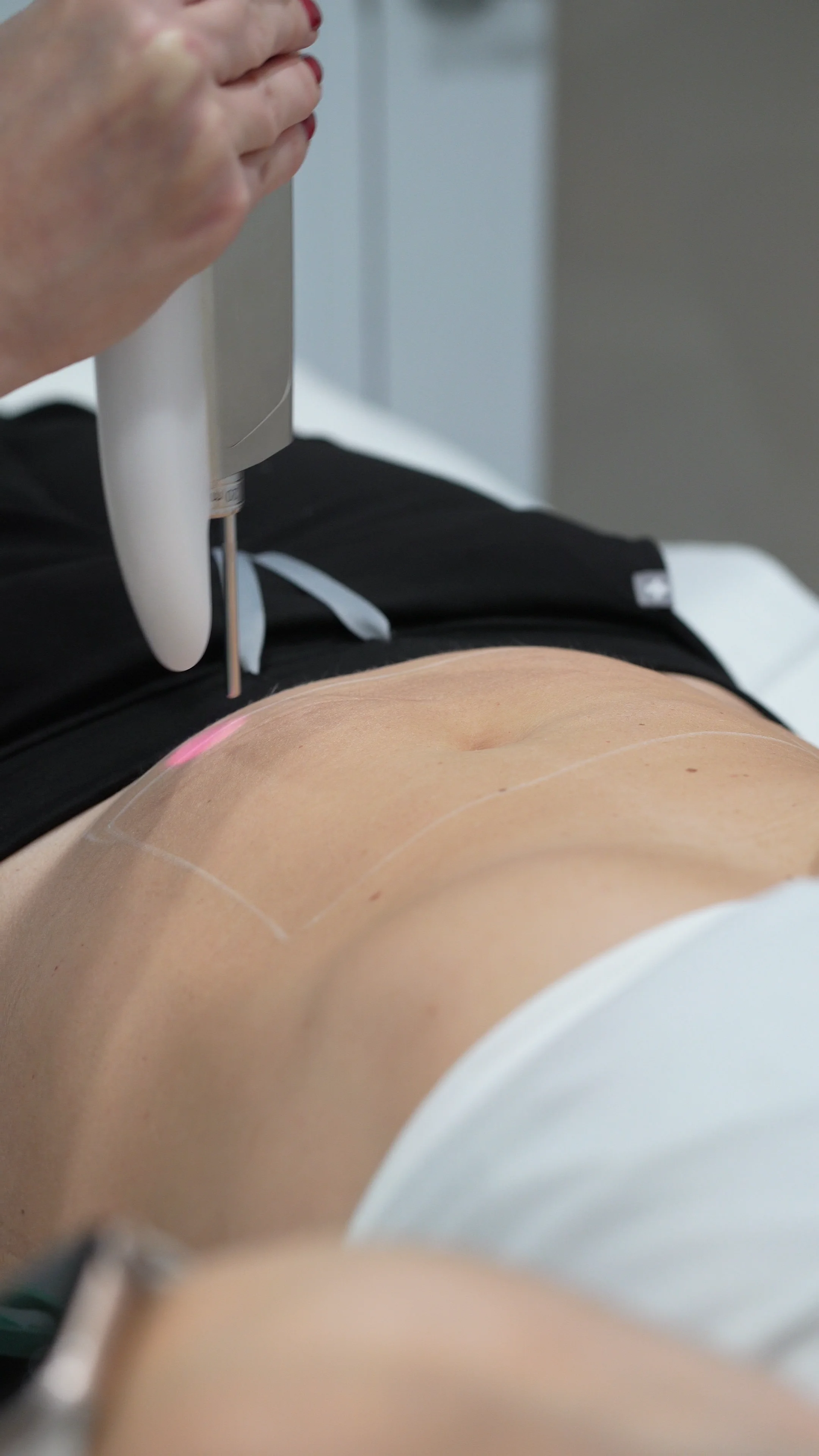 Une personne reçoit un traitement au laser sur l'abdomen tout en étant allongée, avec une zone marquée au préalable.