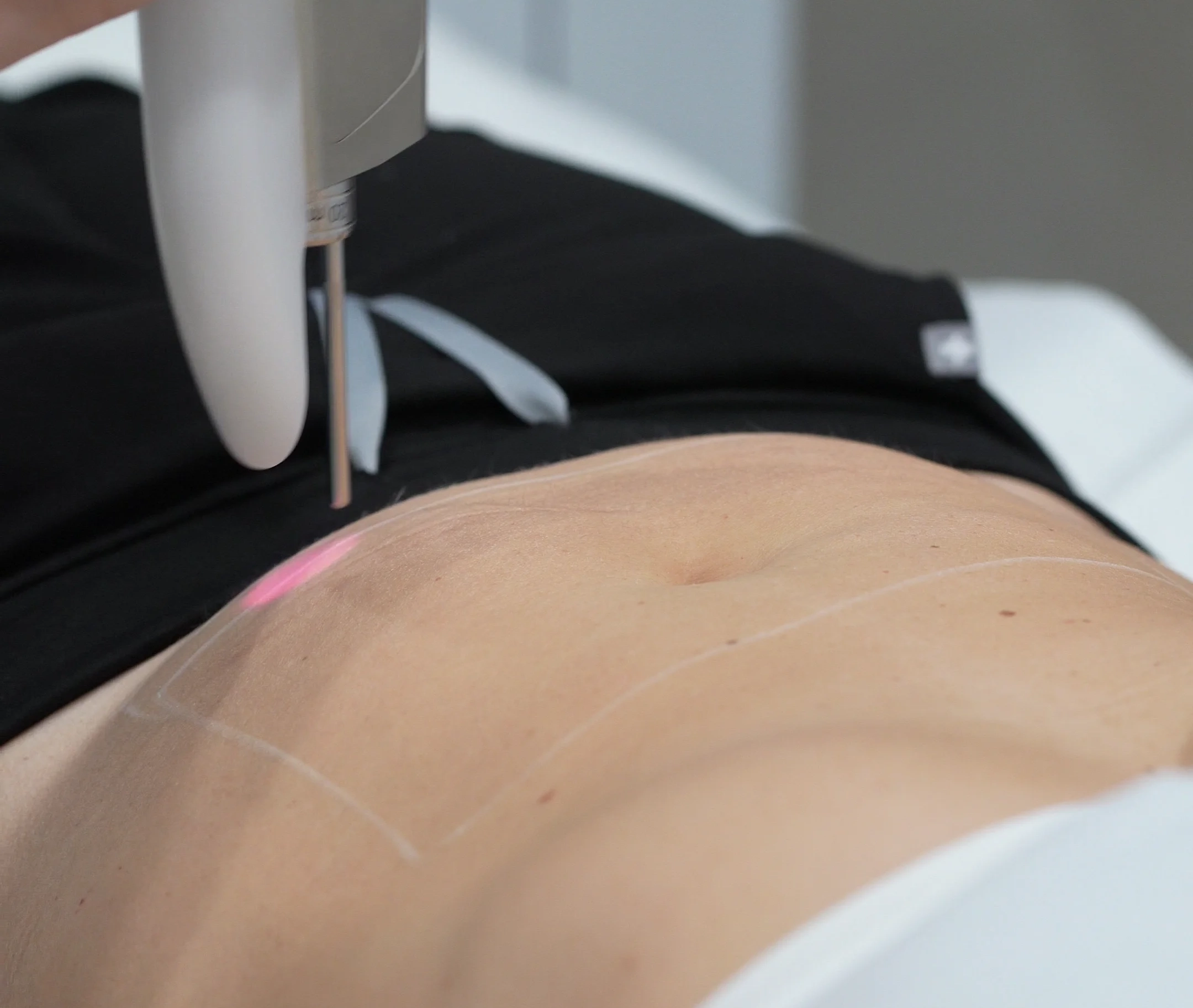 Traitement de sculpture corporelle au laser sur l'abdomen d'une personne allongée.