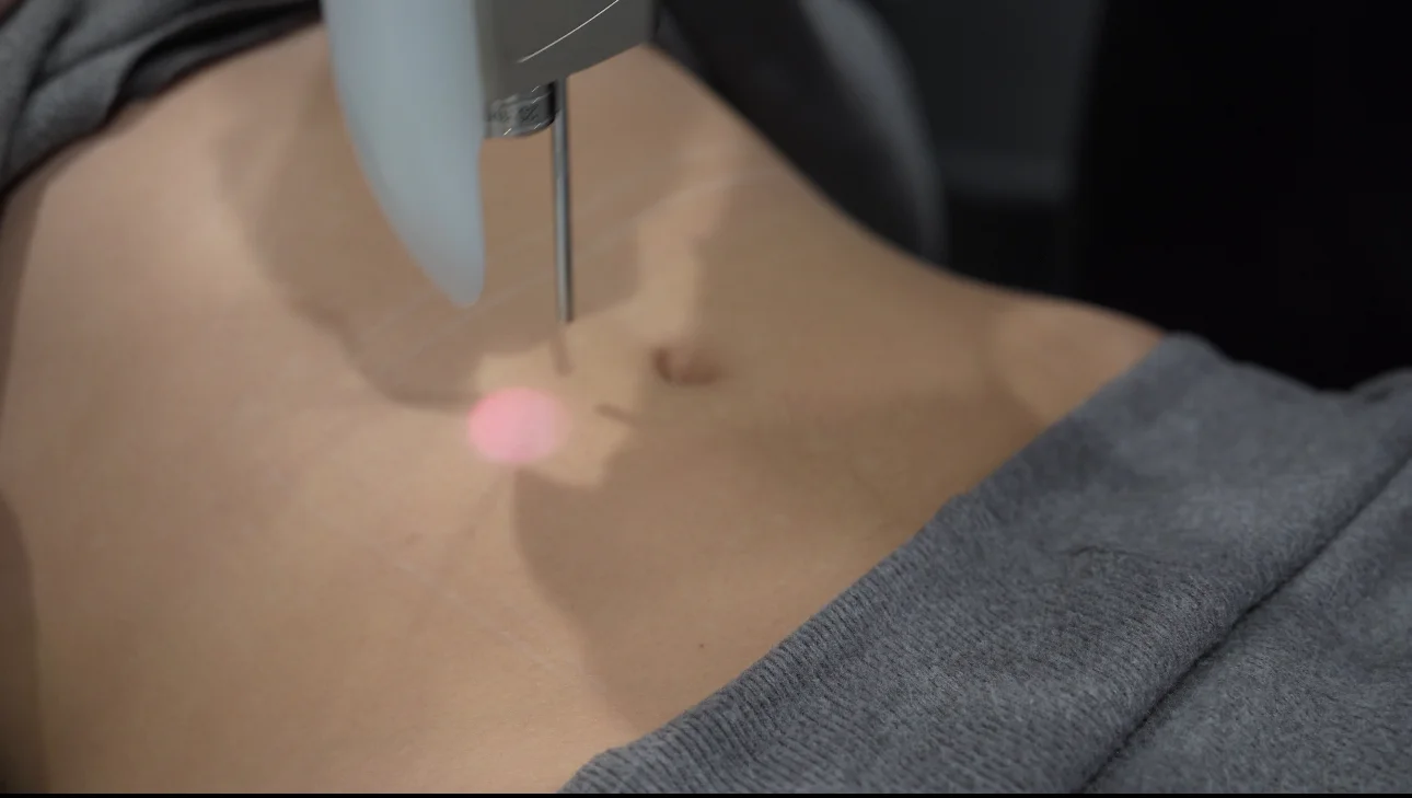 Procédure de sculpture corporelle utilisant un dispositif laser sur l'abdomen d'une personne.