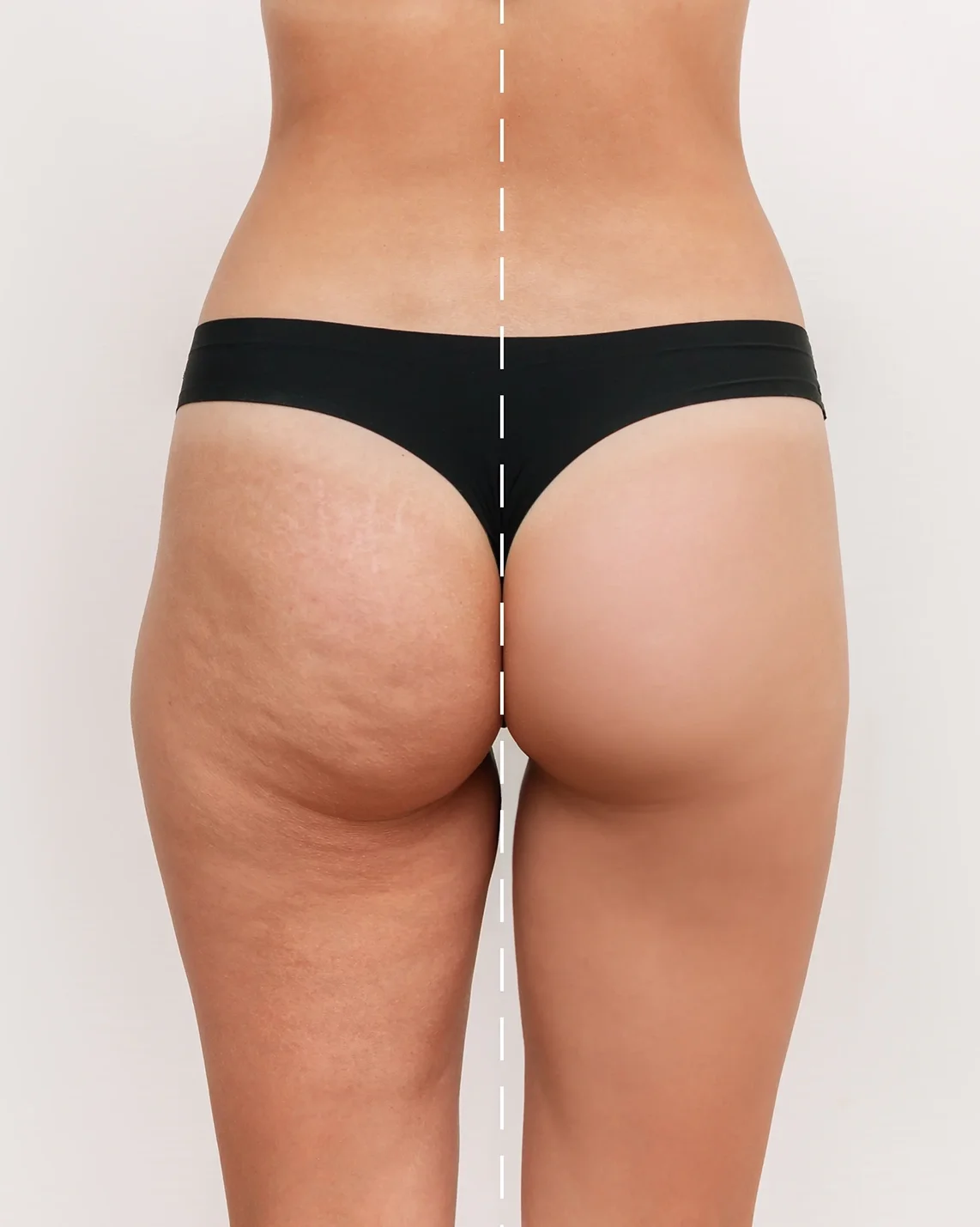 Vue arrière d'une personne portant une culotte noire avec la peau d'une fesse montrant de la cellulite et l'autre fesse lisse, séparées par une ligne verticale blanche. Clinique médico-esthétique SkinIn Quartier Dix30