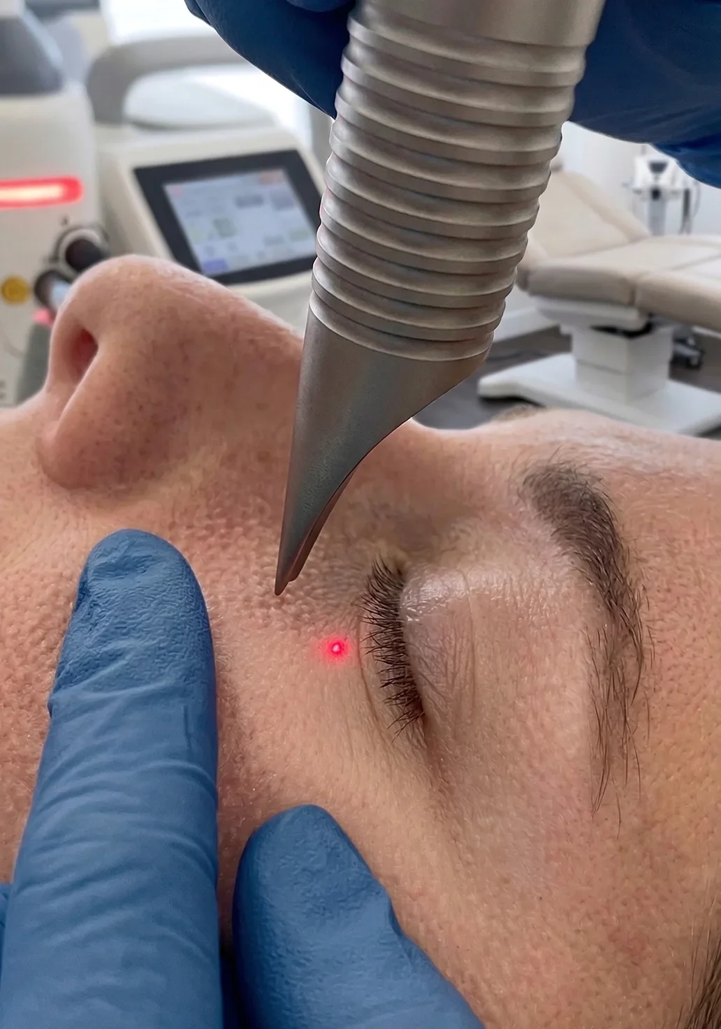Traitement laser du contour des yeux avec technologie Fotona, ciblant les ridules et le relâchement sous l’œil.
