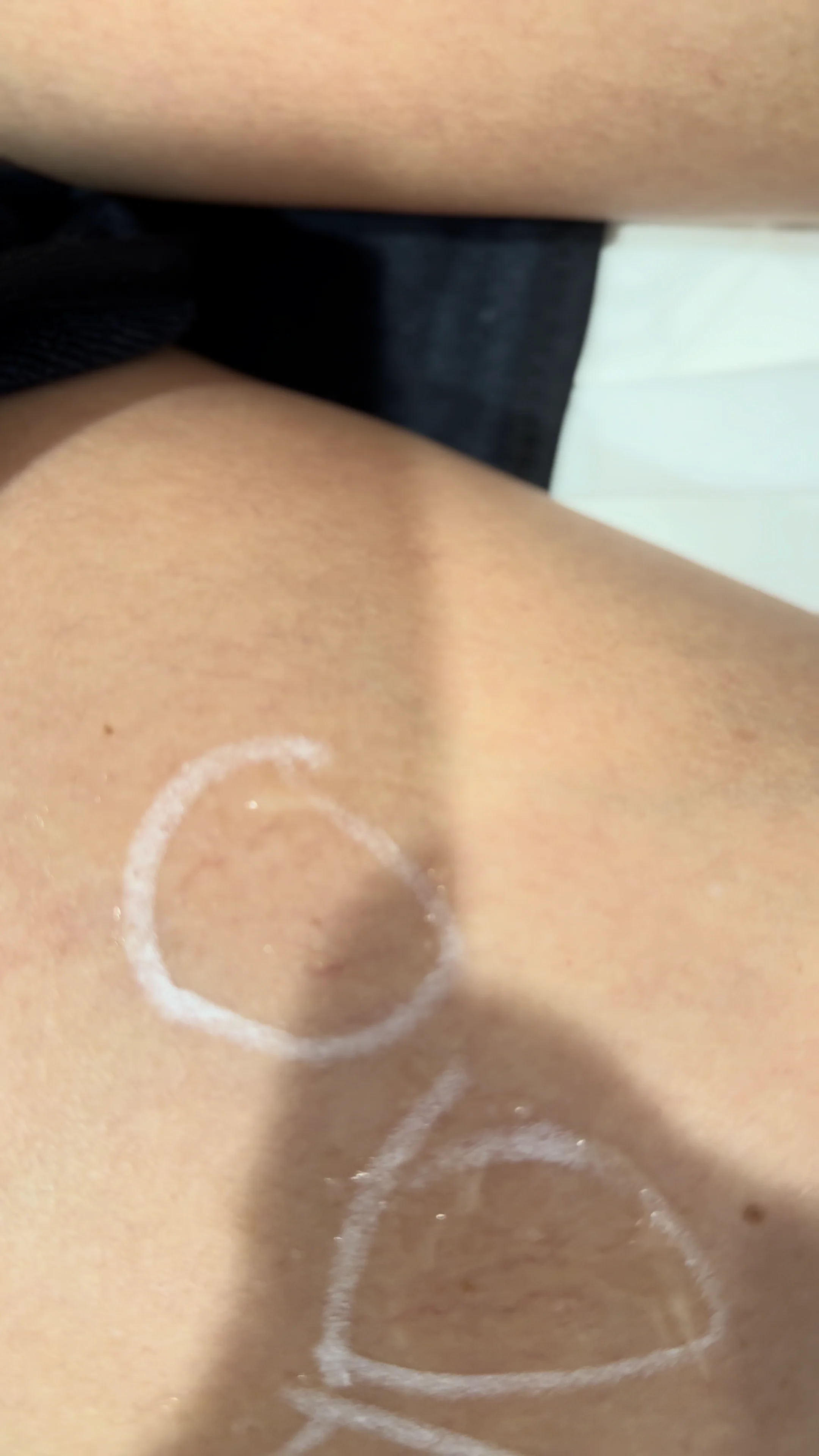 Peau de jambe avec des varices visibles encerclées en blanc. Clinique SkinIn, brossard