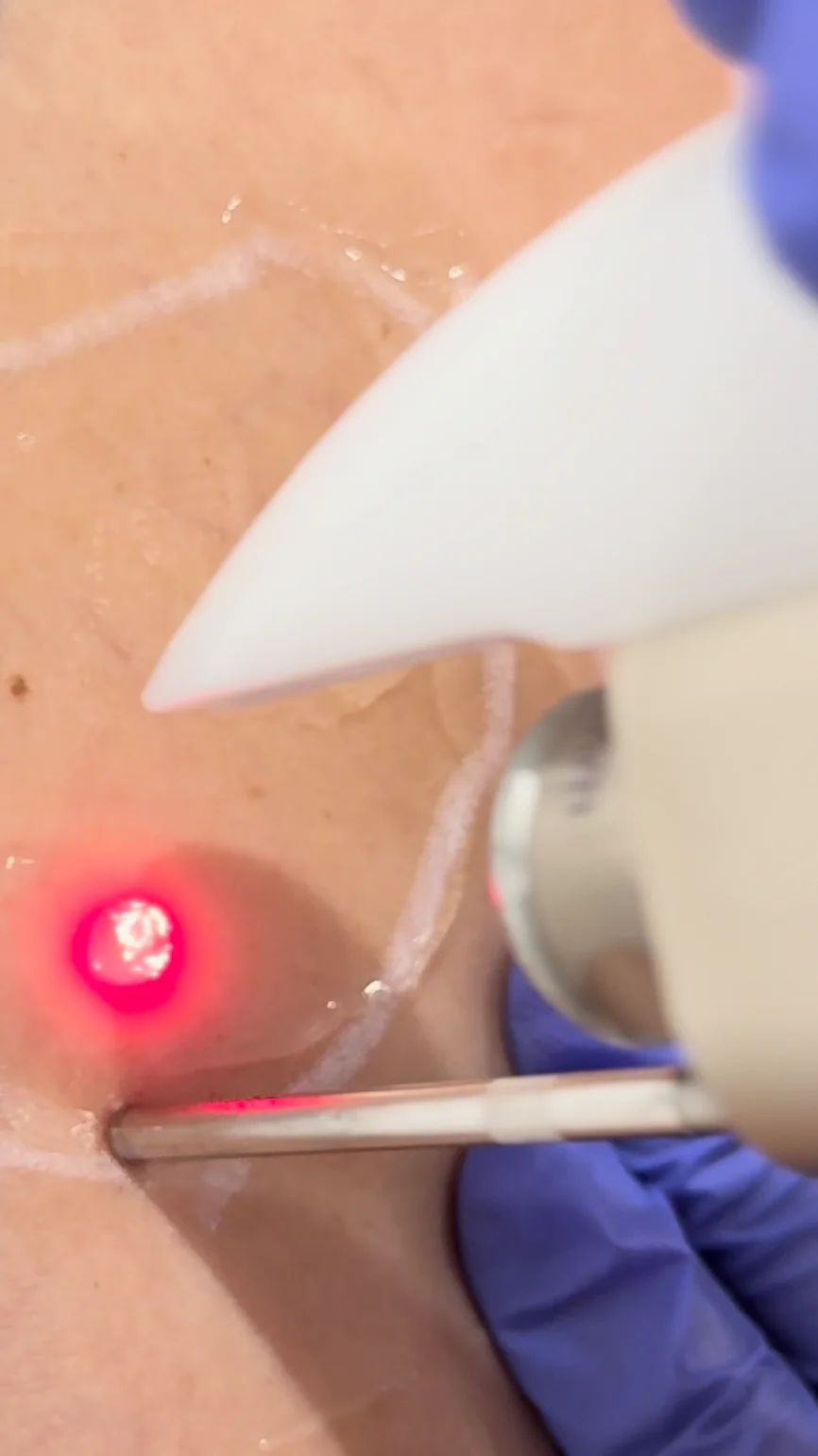 Traitement au laser sur une peau marquée pour cibler une varice avec un faisceau lumineux rouge, main gantée tenant l'appareil. Clinique SkinIn, brossard