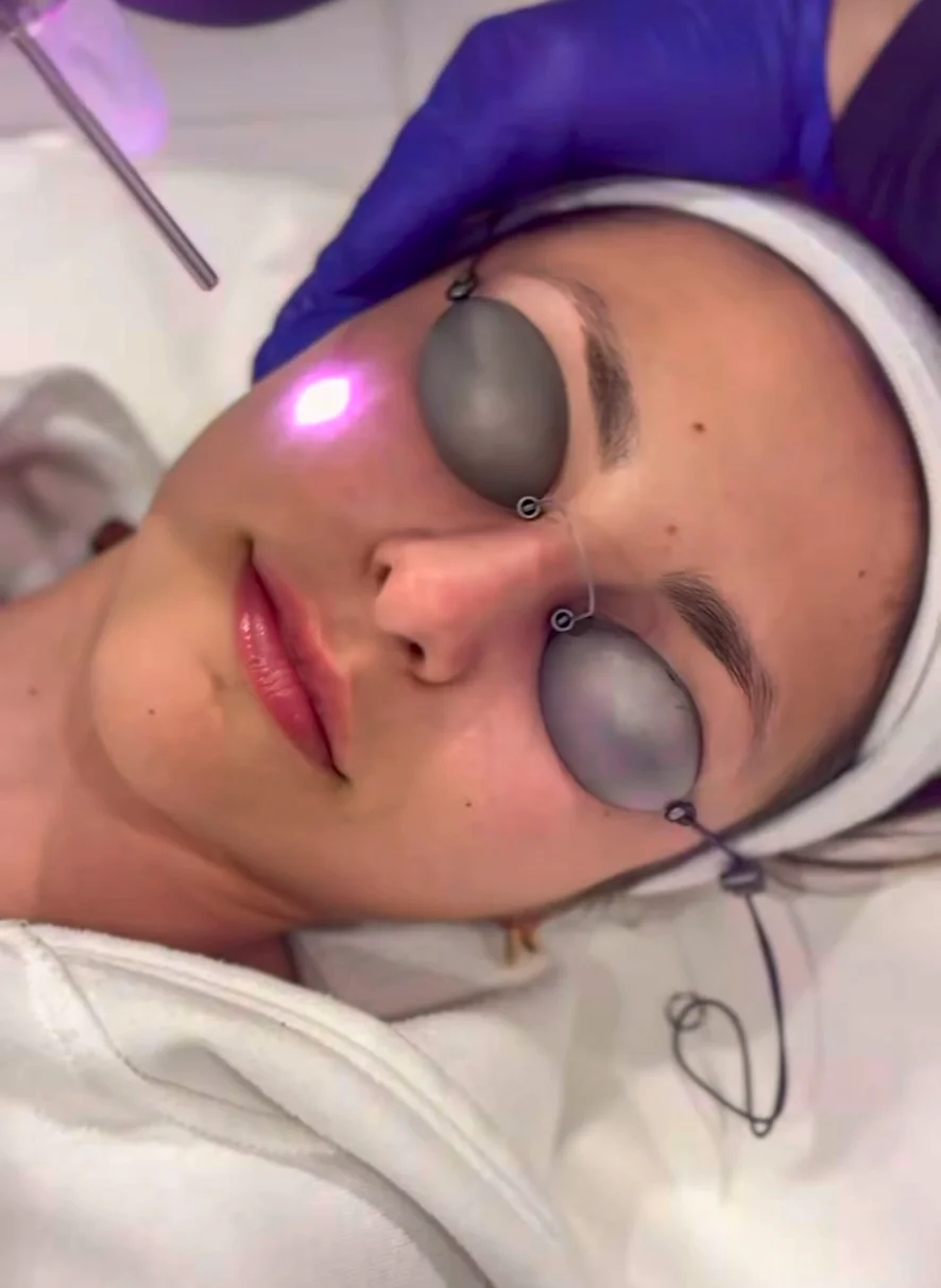 Person receiving facial laser treatment with protective eye covers, glowing purple light on cheek. Clinique SkinIn, brossard