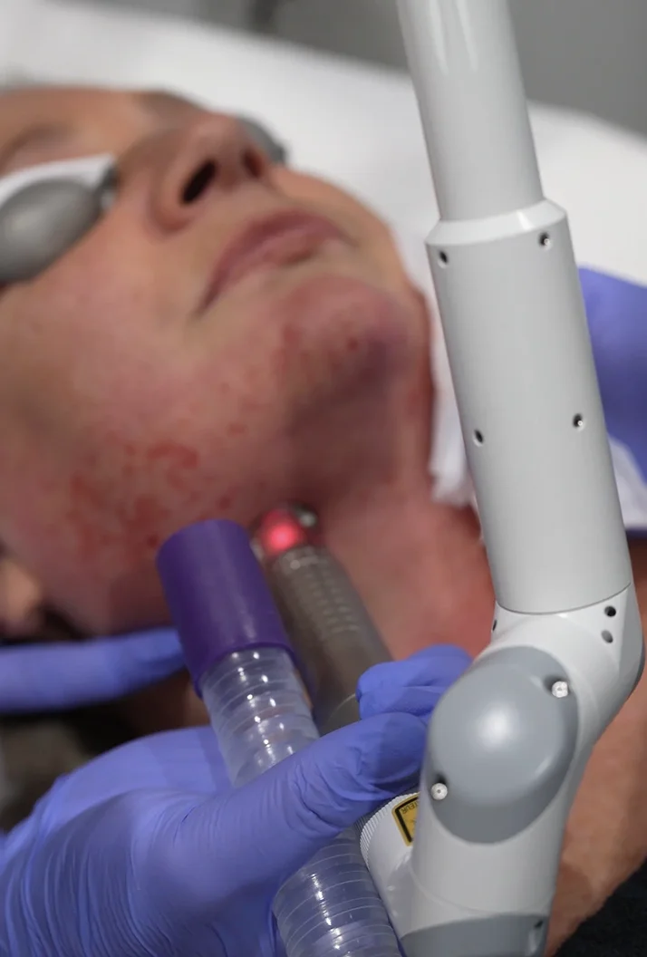 Person recevant un traitement facial au laser sur le menton, avec des lunettes de protection et un praticien portant des gants bleus tenant l'appareil.