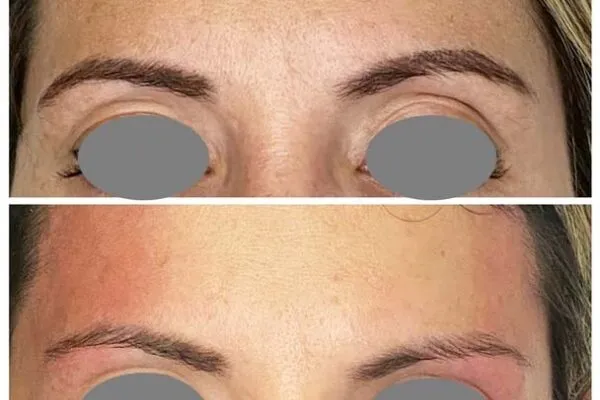 Avant et après d'une zone du front et des sourcils montrant une peau plus lisse et plus tendue après traitement.