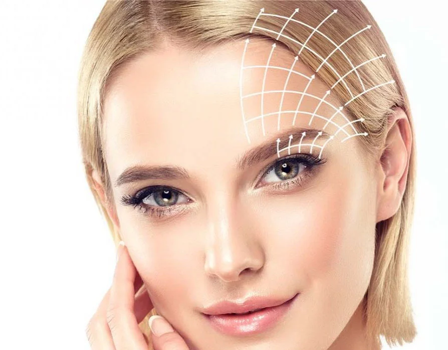 Visage d'une femme blonde au teint clair avec des lignes blanches illustrant le lifting du visage au-dessus de son front et autour de son œil droit.