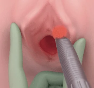 Vue intérieure illustrée du vagin montrant un dispositif médical appliquant un traitement localisé avec une lumière rouge.