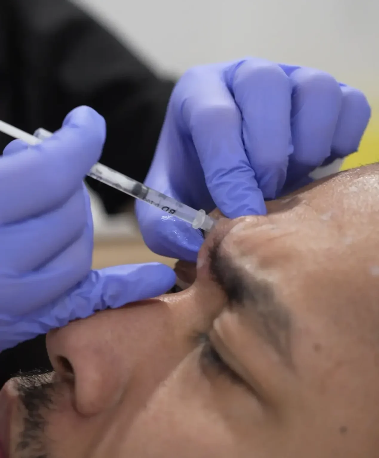Un professionnel de la santé portant des gants bleus injecte un produit dans la zone nasale d'un homme.