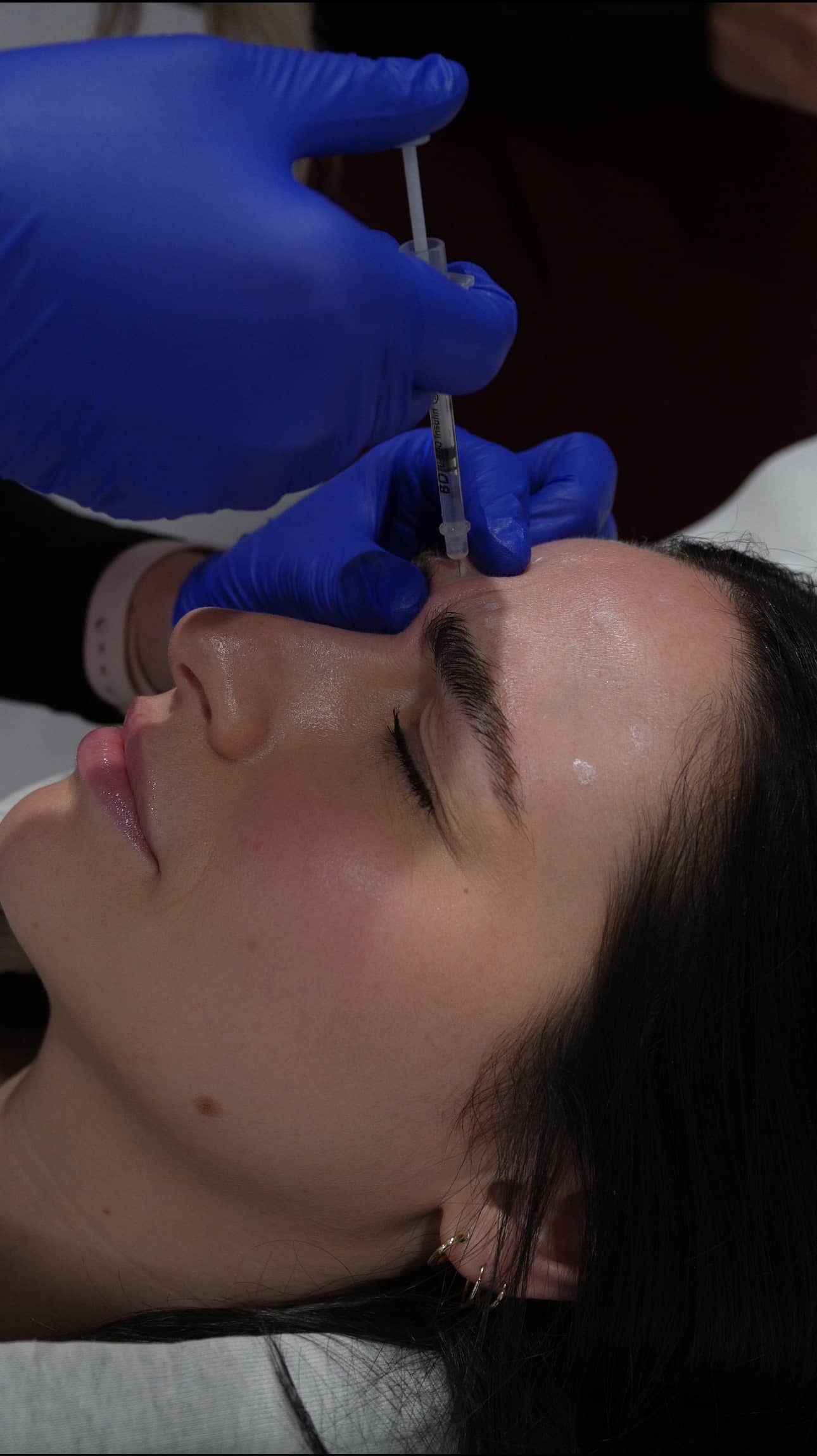 Person recevant une injection de botox, neuromodulateurs à la clinique skinin du quartier dix30 au niveau du front réalisée par une personne portant des gants bleus.