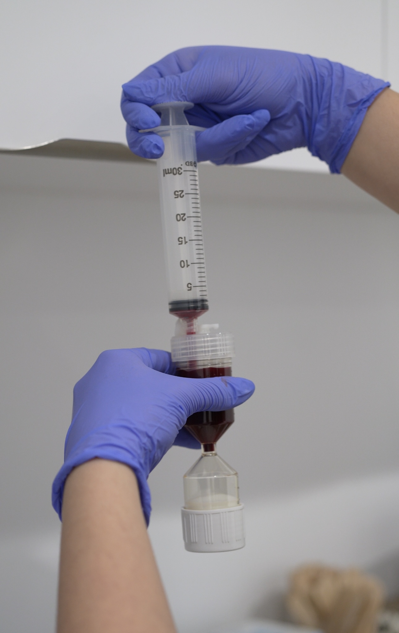 Mains gantées en bleu utilisant une seringue pour prélever un liquide rougeâtre d'un filtre à urine. exosomes clinique skinin