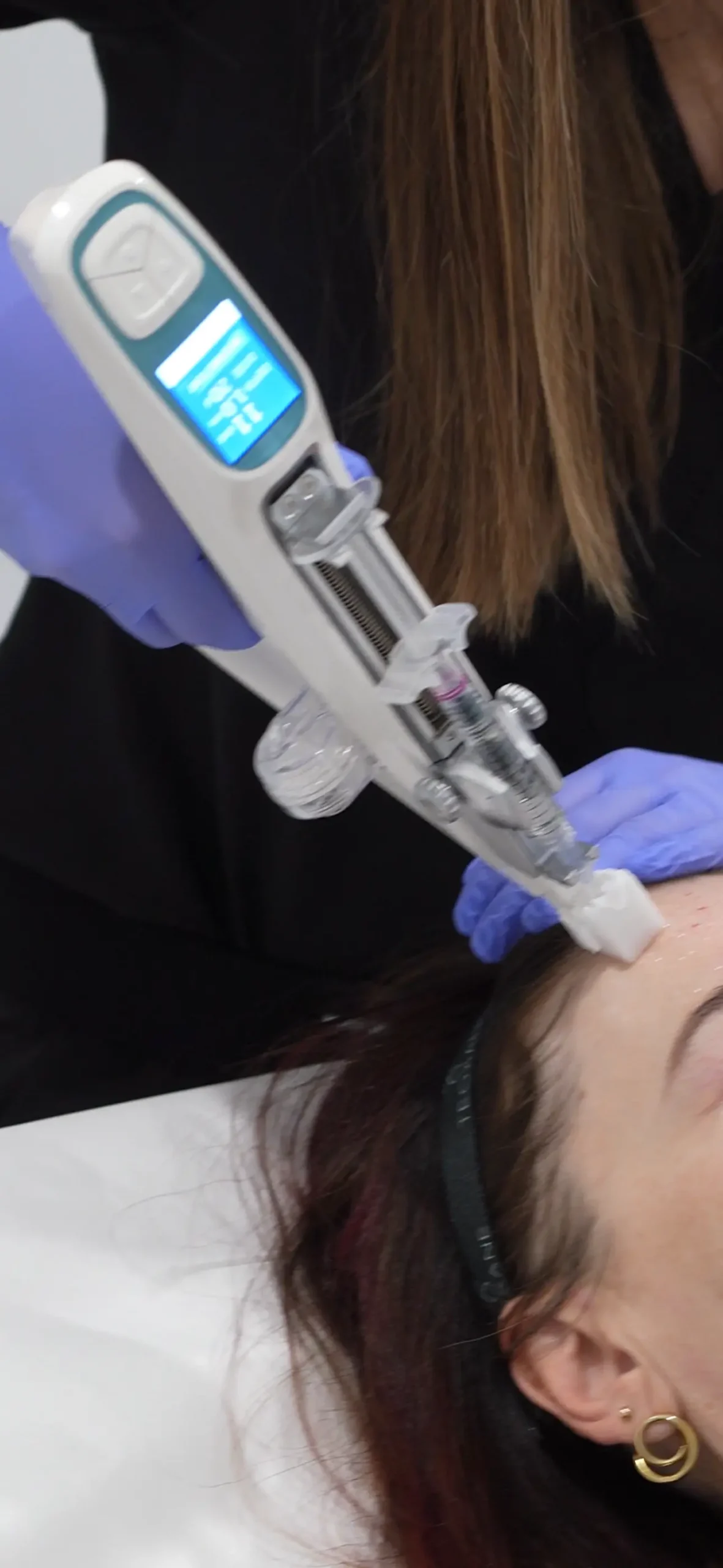 Un traitement de la peau au front avec un dispositif médical automatisé tenu par une personne portant des gants violets.