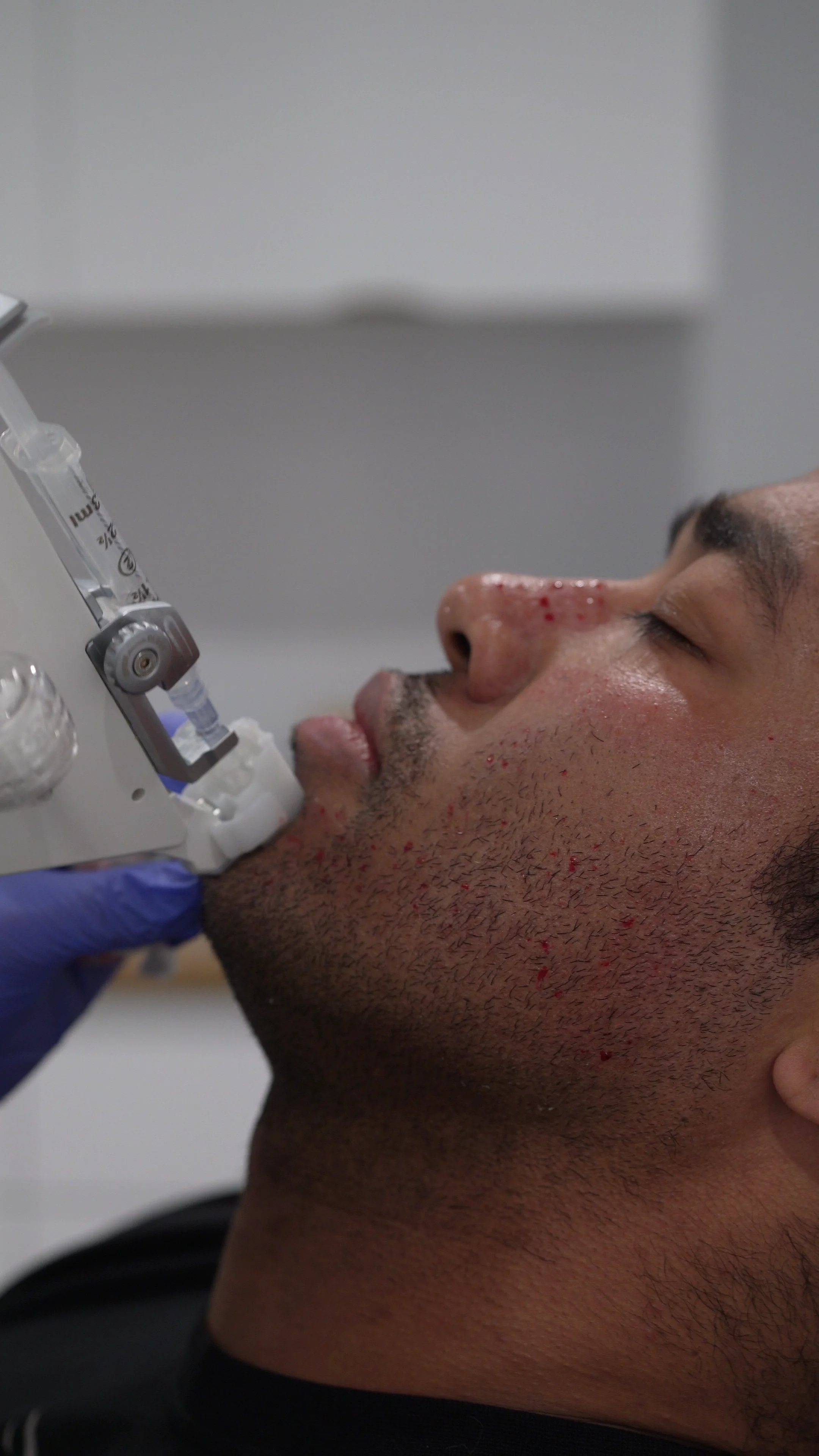 Homme recevant un traitement esthétique au visage avec un appareil médical, petites traces de sang visibles sur la peau. Skin Booster clinique Skinin