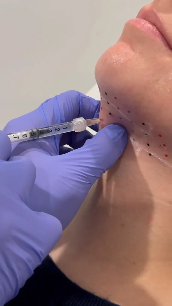 Injection sous le menton avec un stylo à aiguille par une main gantée bleue, avec des points colorés marquant les zones d'injection.