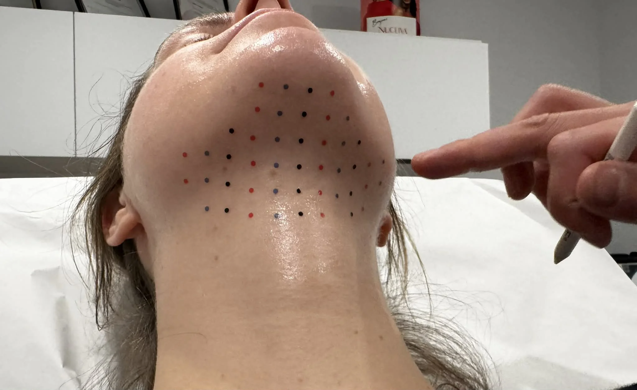 Marqueur de points noirs et rouges sur le menton d'une personne allongée, avec une main tenant un stylo proche du visage.