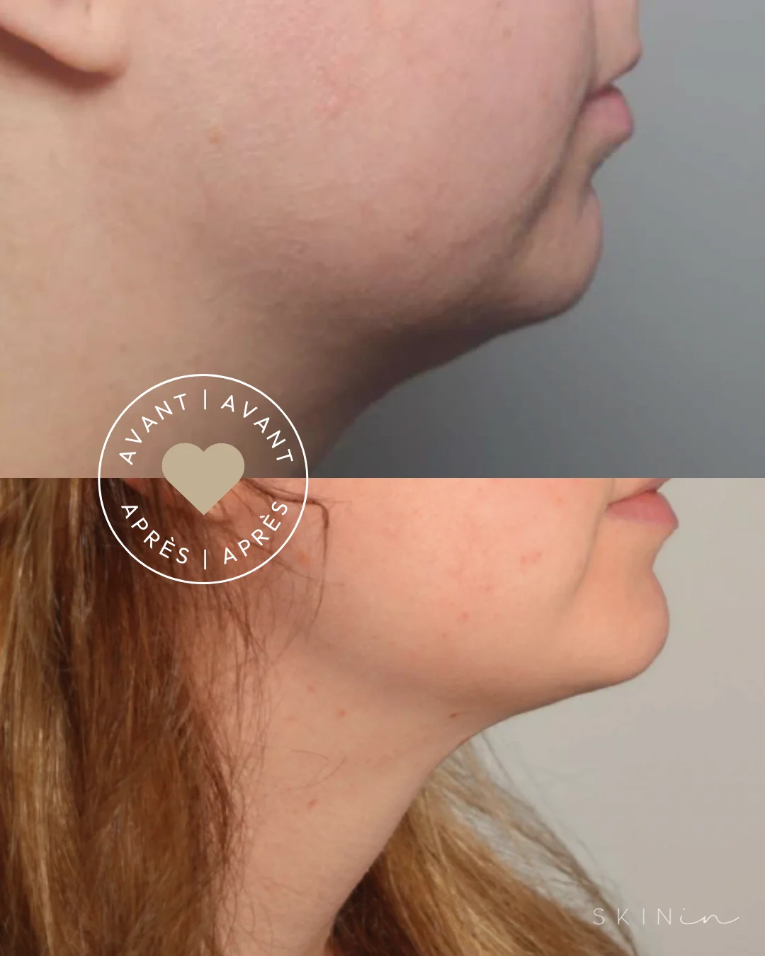 Vue de profil du menton et du cou d'une femme avant et après un traitement esthétique, montrant une réduction visible de la graisse sous le menton. Traitement Belkyra à la clinique Skinin à brossard