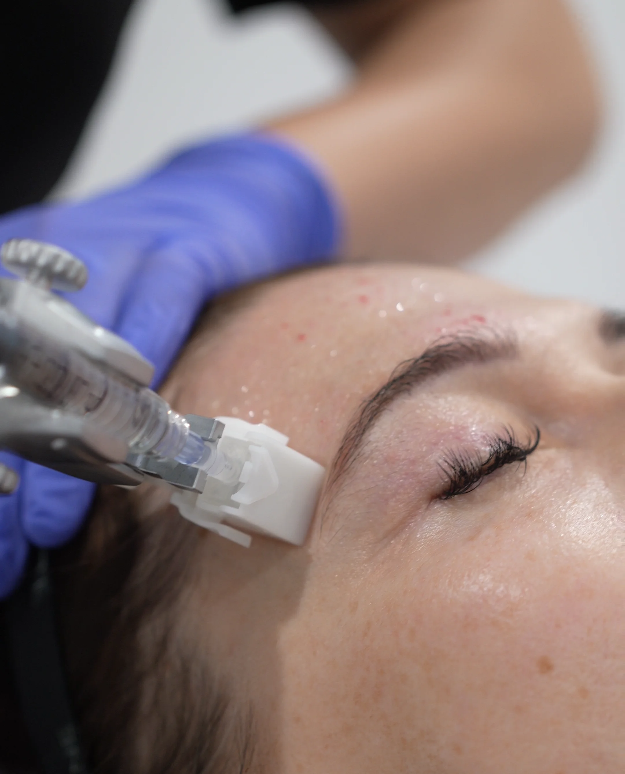 traitement de soin de la peau au visage avec une aiguille par un professionnel portant des gants bleus. Skin Booster à la clinique médico-esthétique SkinIn