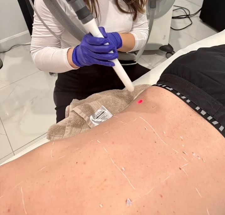 Une personne reçoit un traitement au laser d'épilation à la clinique skinin à brossard sur le dos réalisé par un professionnel portant des gants bleus.