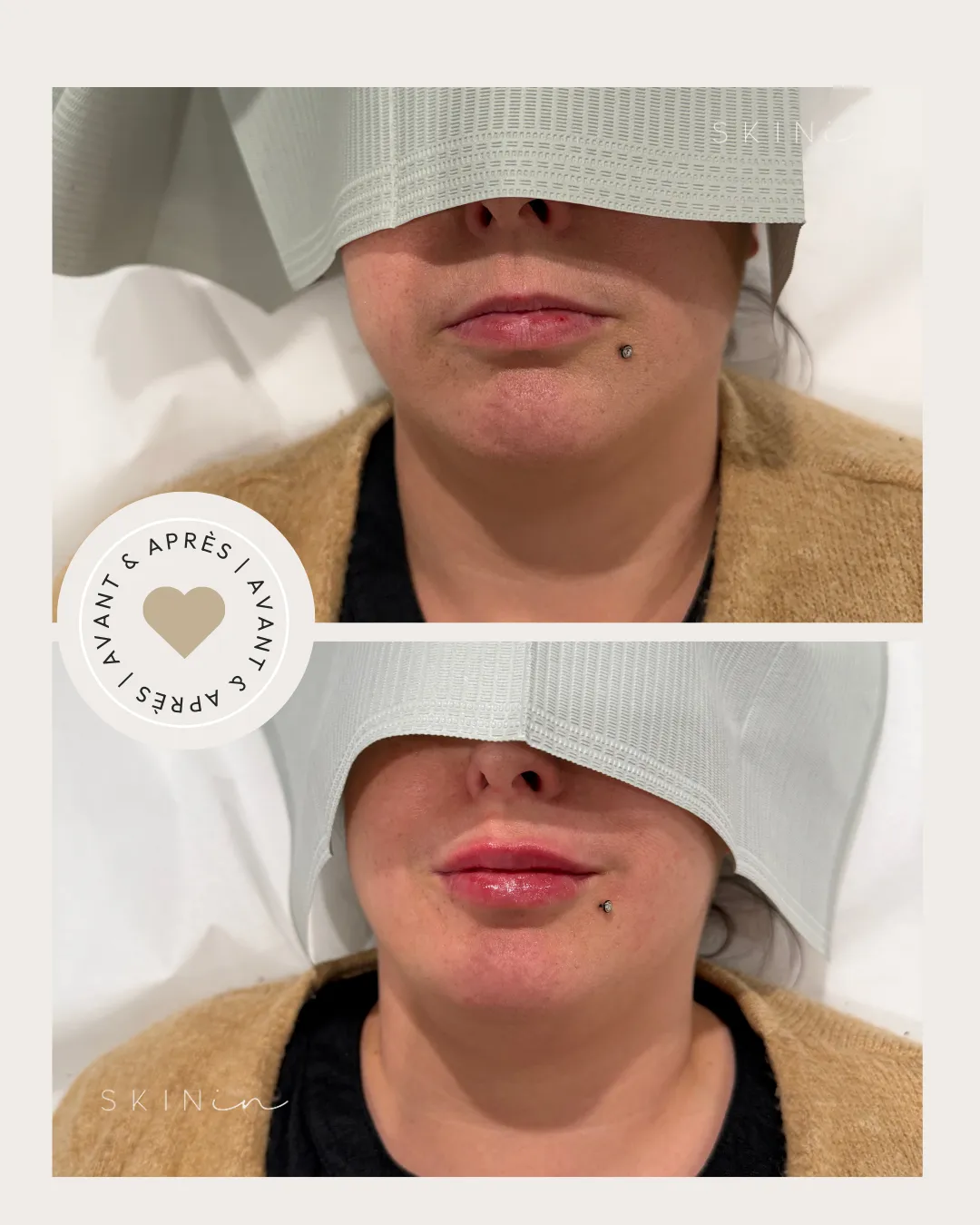 Vue avant et après d'une personne avec un piercing sur le menton, montrant des lèvres repulpées et hydratées après traitement.