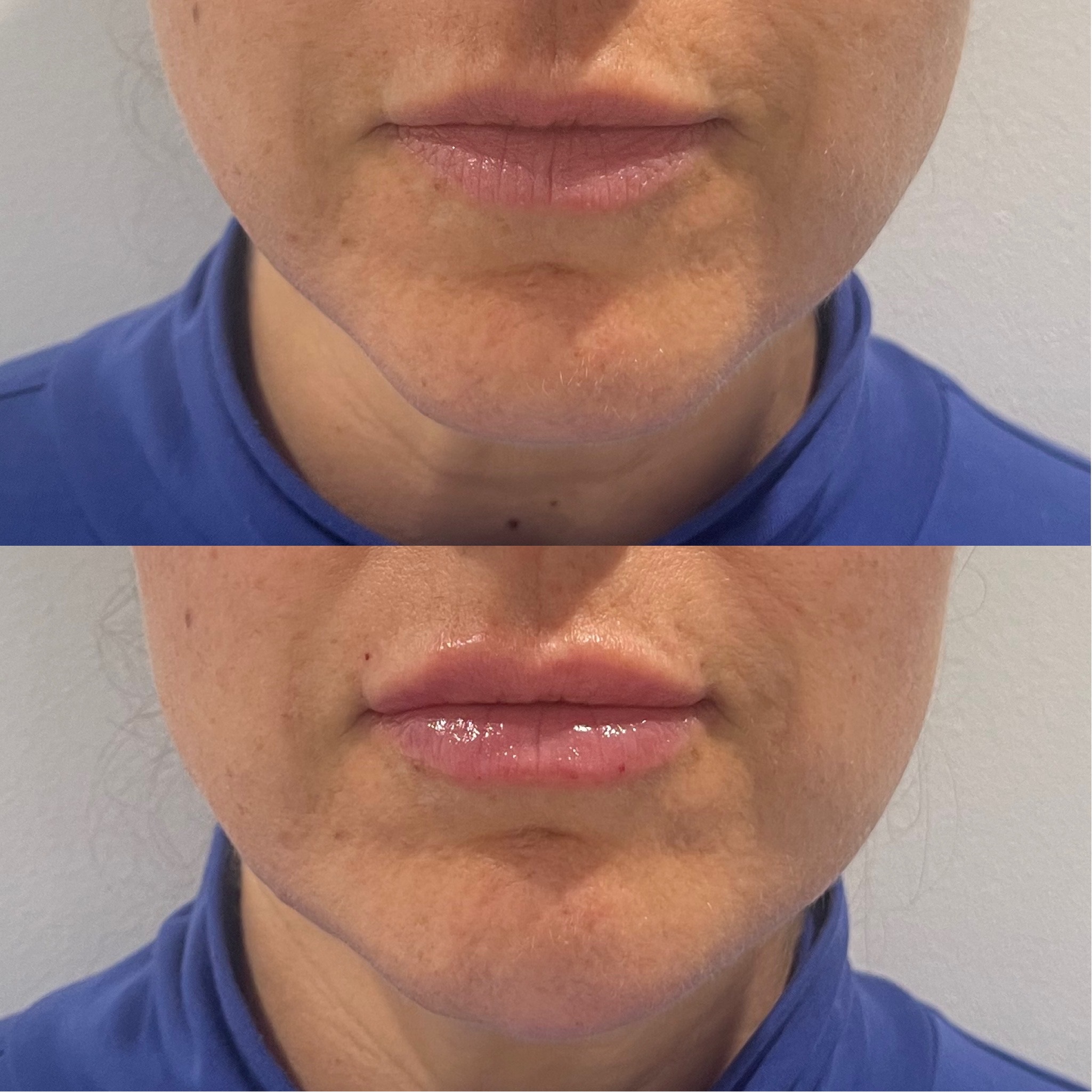 Comparaison avant et après d'une bouche de femme montrant des lèvres plus pulpeuses après un traitement cosmétique.
