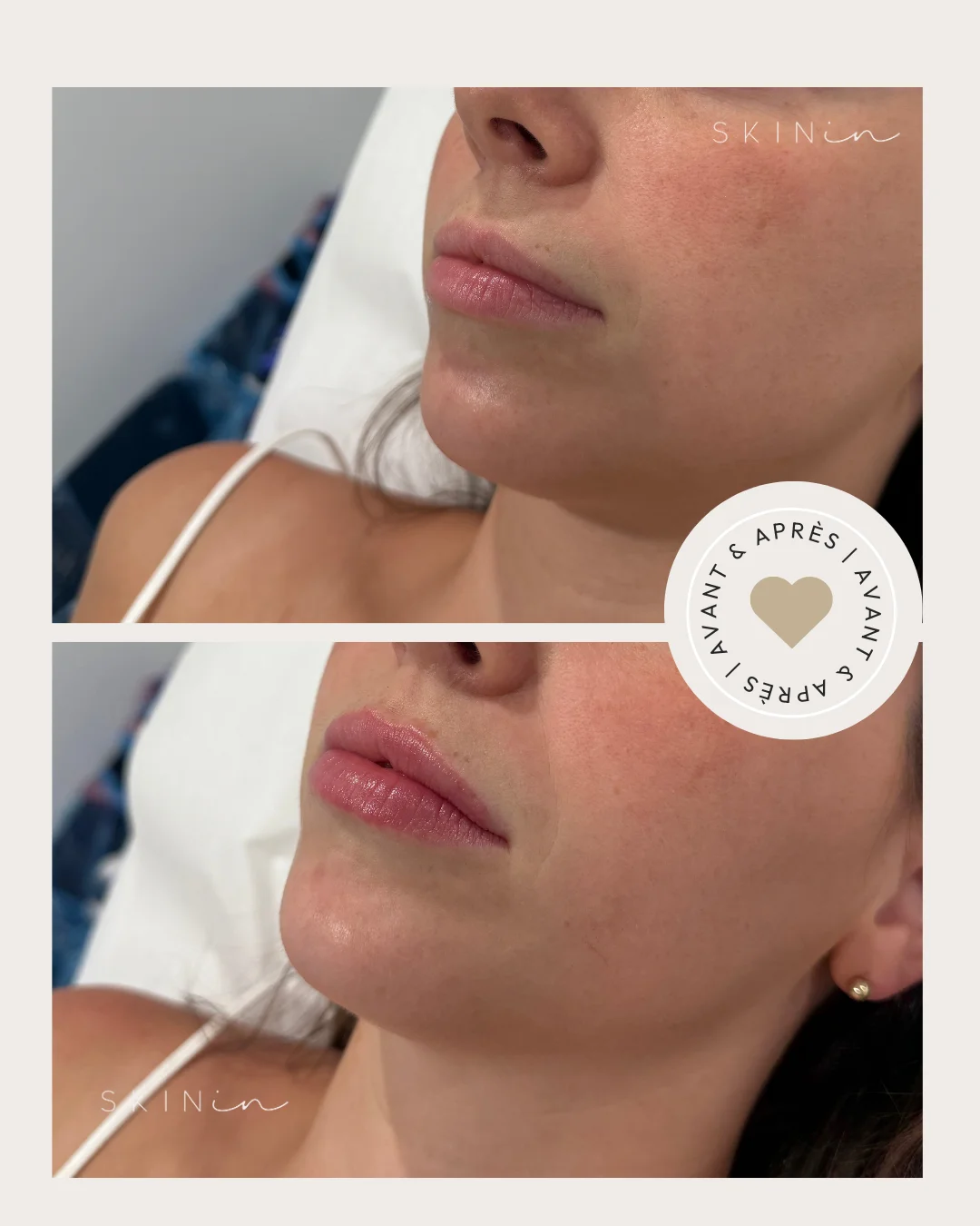 Portrait en gros plan des lèvres d'une femme avant et après un traitement esthétique avec des lèvres plus pulpeuses et définies après.