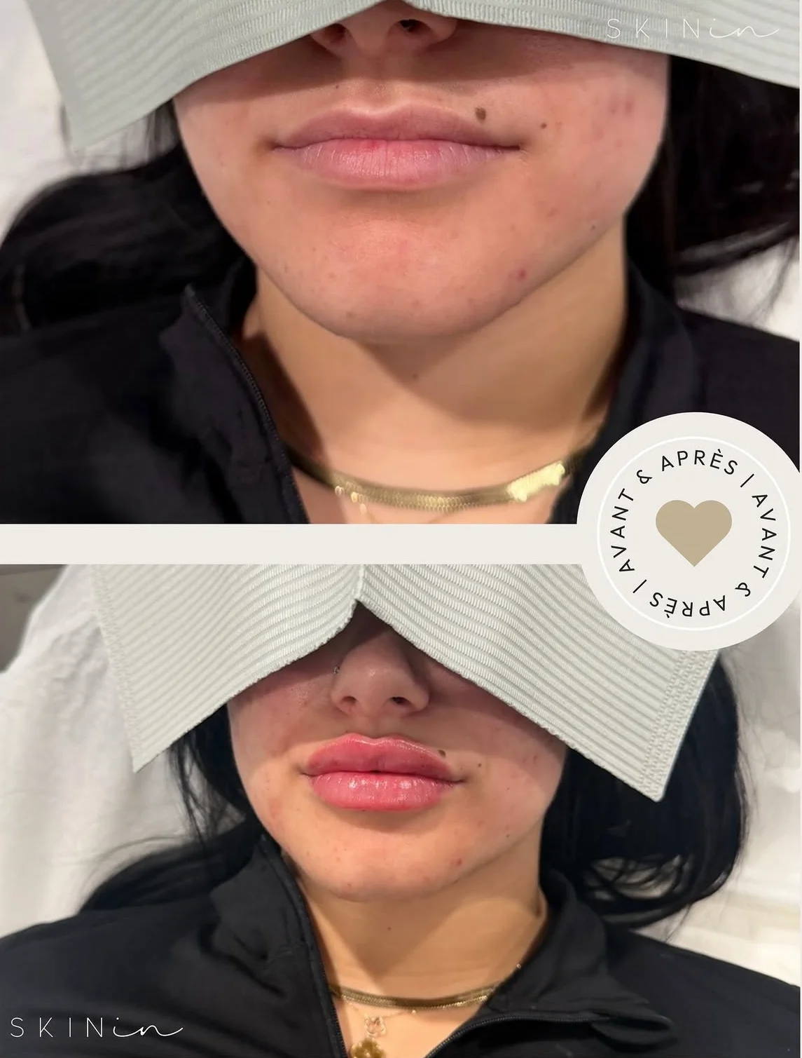 Portrait en gros plan des lèvres d'une femme avant et après un traitement esthétique avec des lèvres plus pulpeuses et définies après.