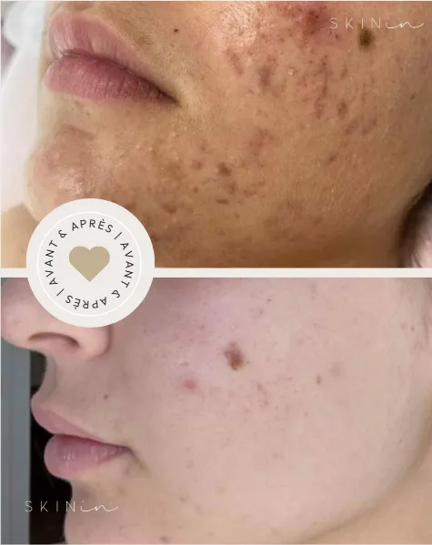 Comparaison avant et après du visage d'une personne montrant une amélioration visible de l'acné et des cicatrices sur la joue. clinique skinin